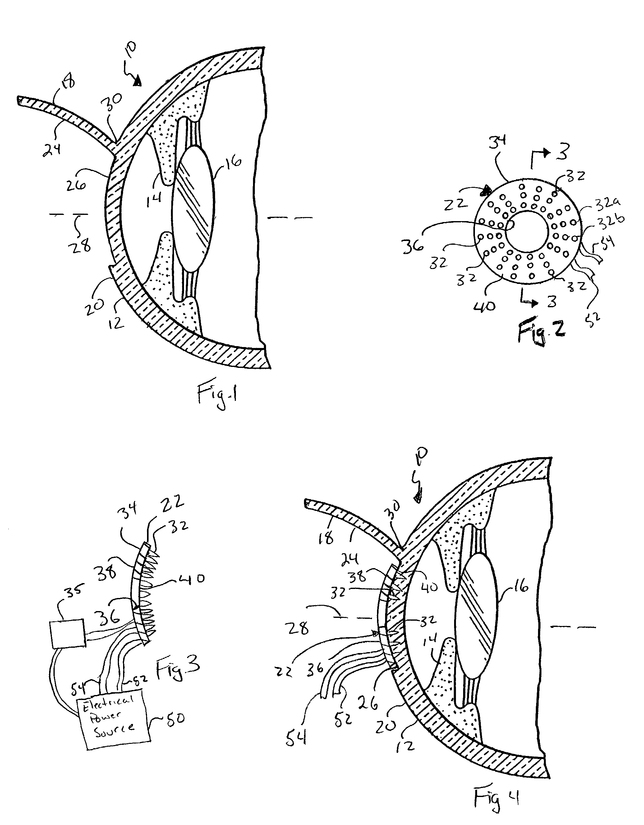 Method and apparatus for corneal shrinkage using a plurality of electrodes