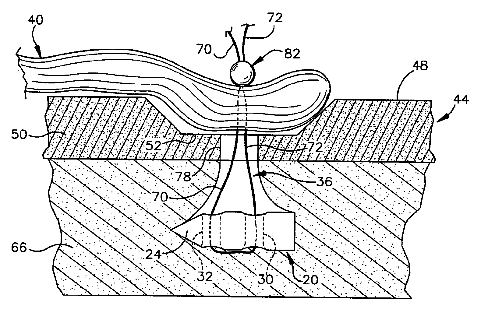 Method and apparatus for securing tissue