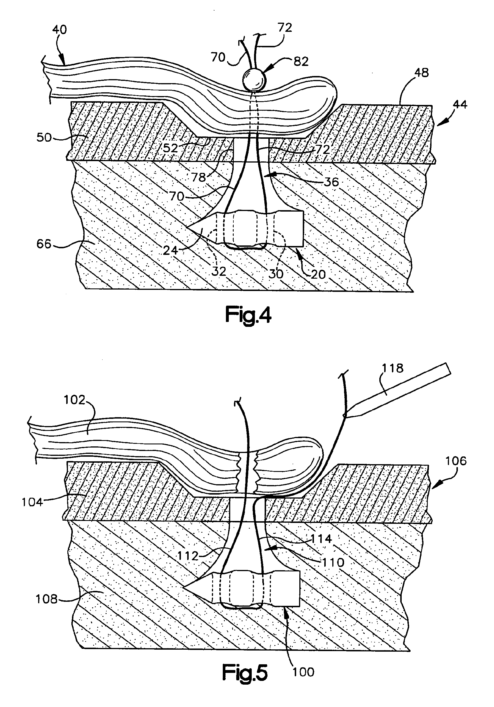 Method and apparatus for securing tissue