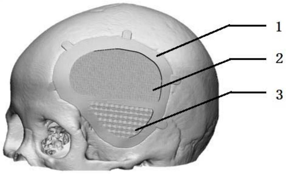 Bone repair material, preparation method thereof and cranio-maxillofacial repair prosthesis