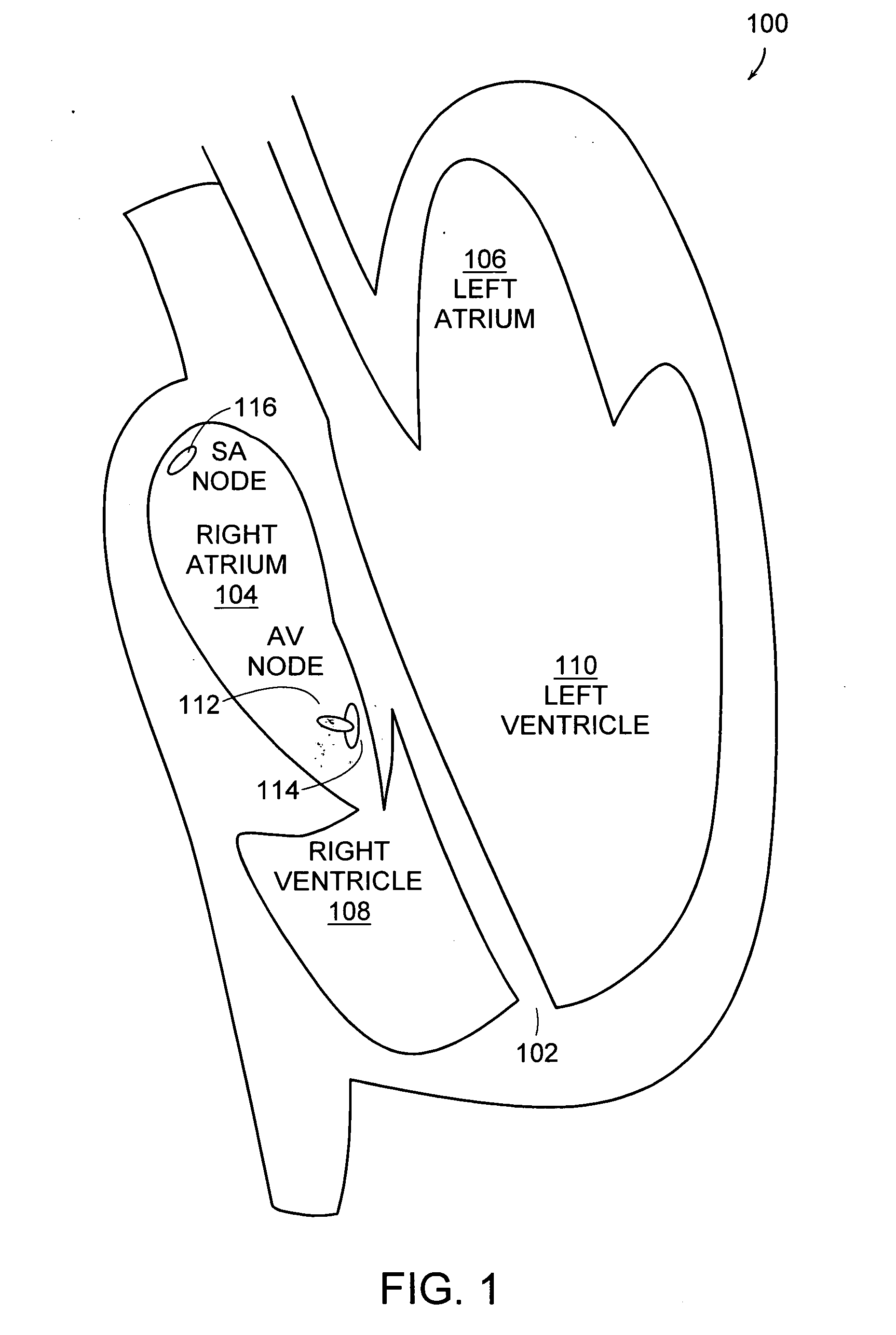 Method and system for detecting premature ventricular contraction from a surface electrocardiogram