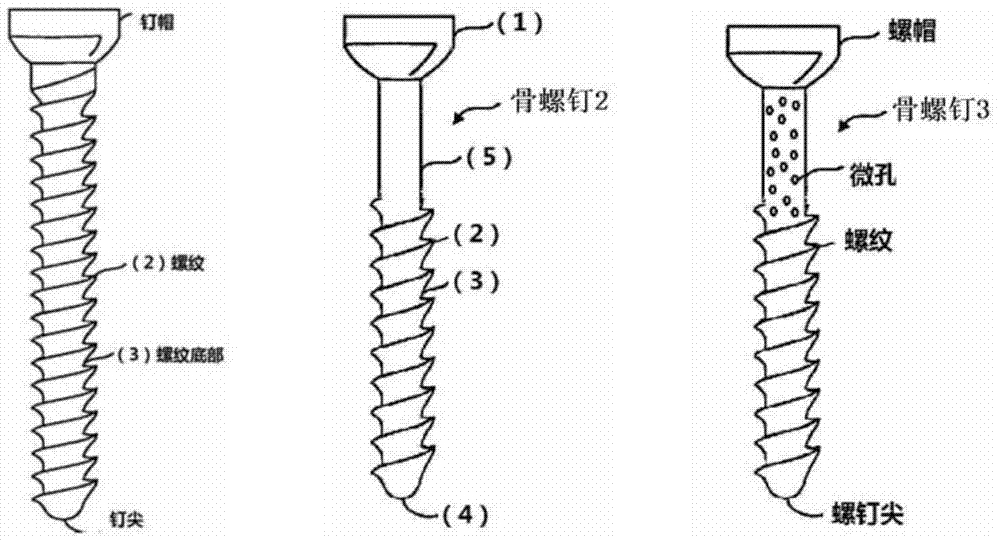 A kind of bone injury repair fixation device and preparation method thereof