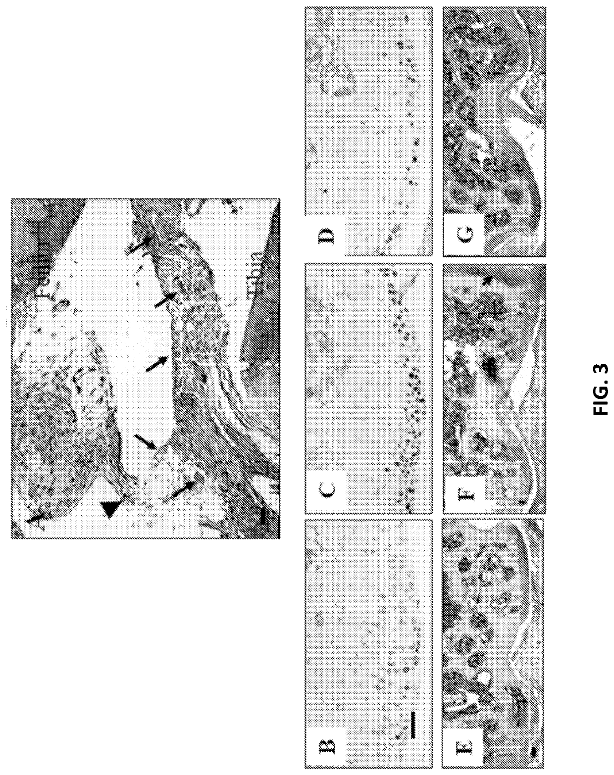 Prevention and Treatment of Osteoarthritis by Inhibition of Insulin Growth Factor-1 Signaling
