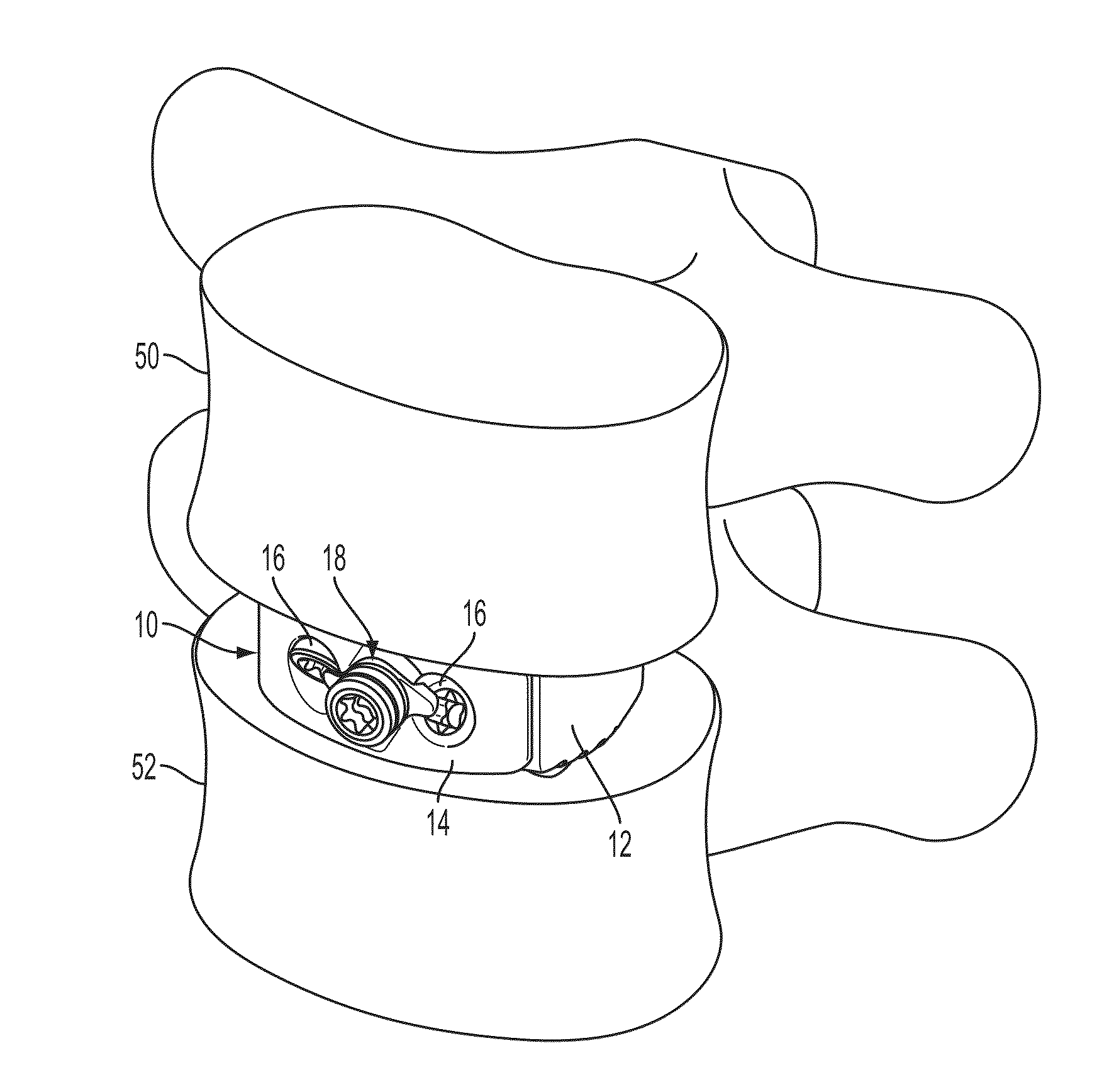 Interbody fusion device and associated methods