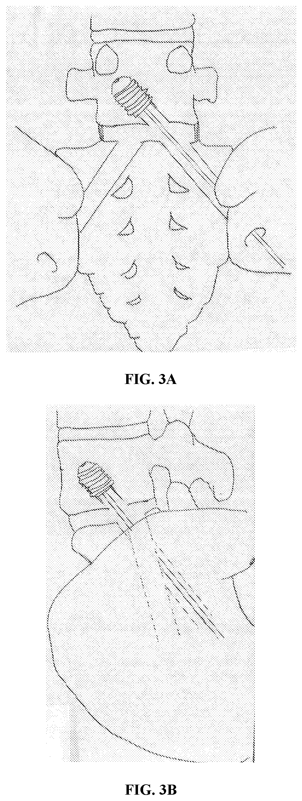 Interlocking implant with expandable fixation means for l5-s1 spinal fusion and/or fixation