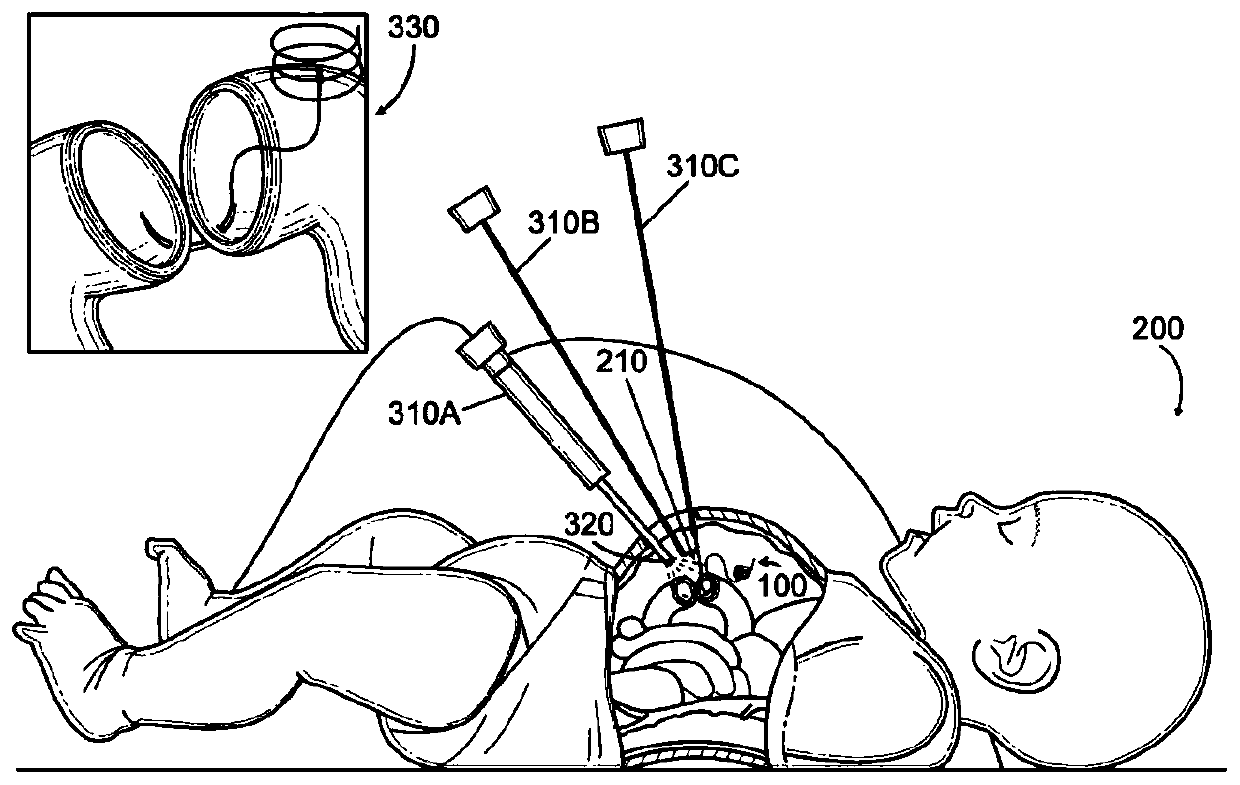 Curled suture device apparatus and method