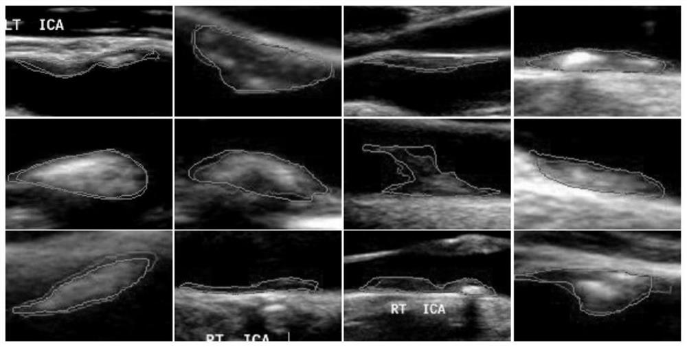 Artery plaque ultrasound image self-supervision segmentation method based on image restoration