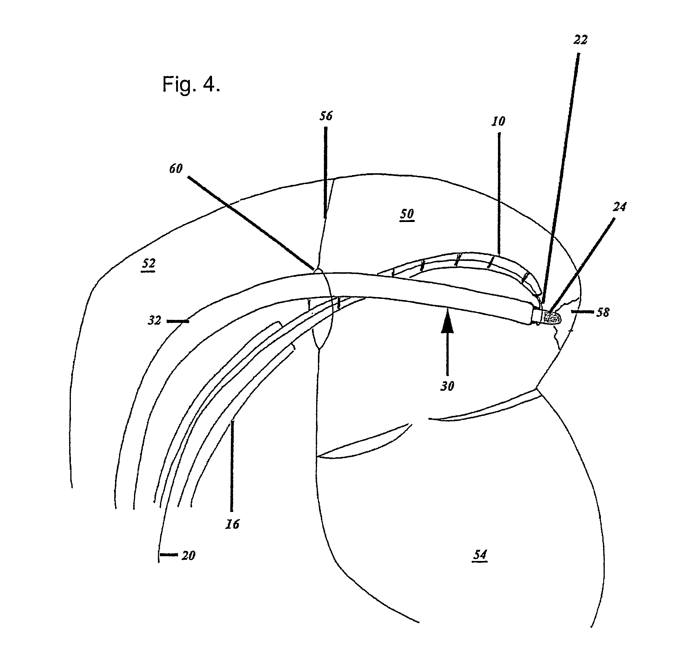 Catheter, apparatus for creating a linear ablation and a method of ablating tissue