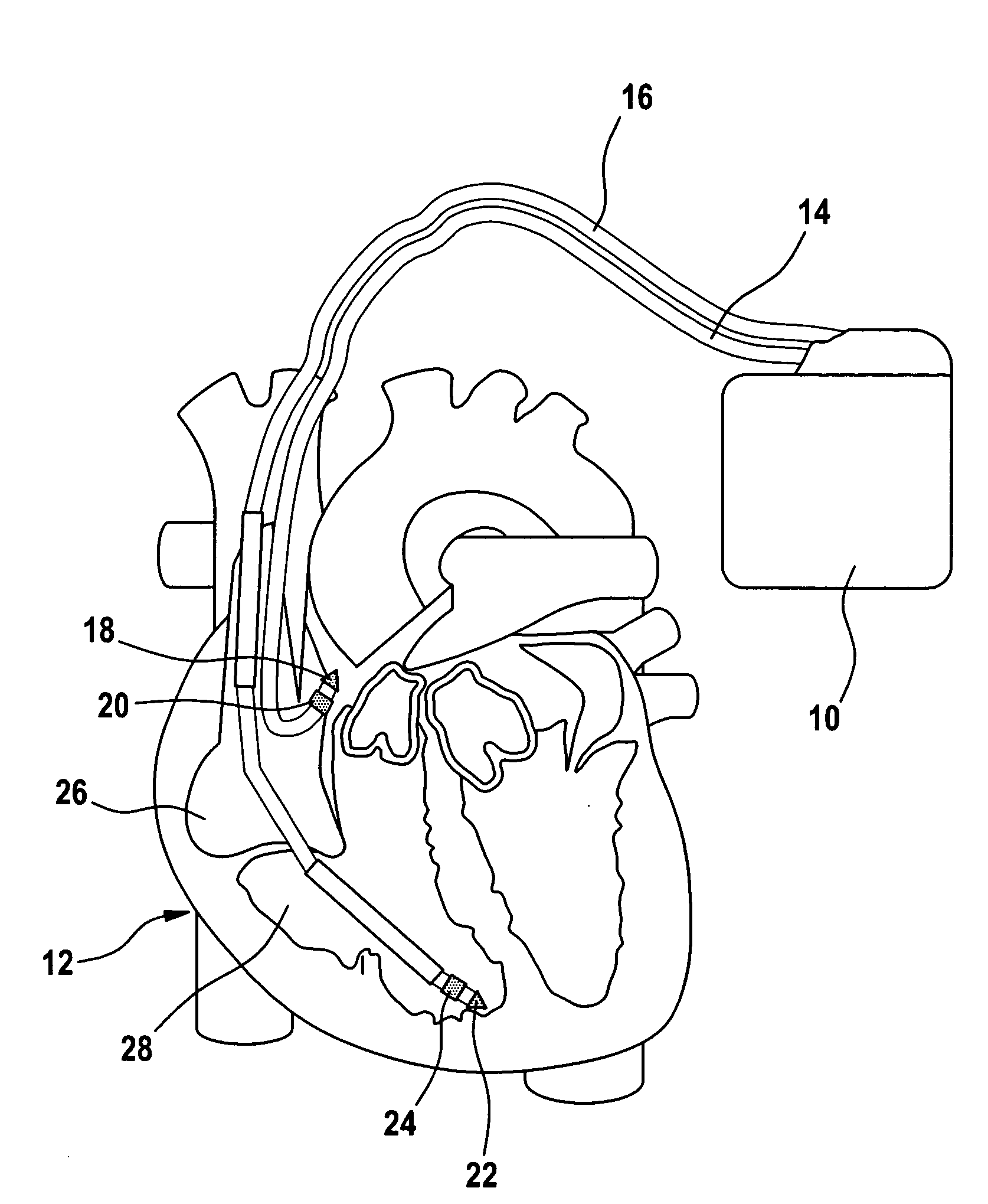 Cardiac pacemaker