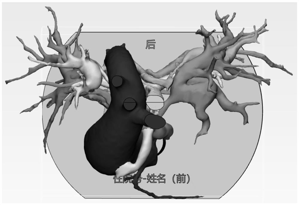 Pulmonary artery atresia combined large main pulmonary collateral vessel model manufacturing method