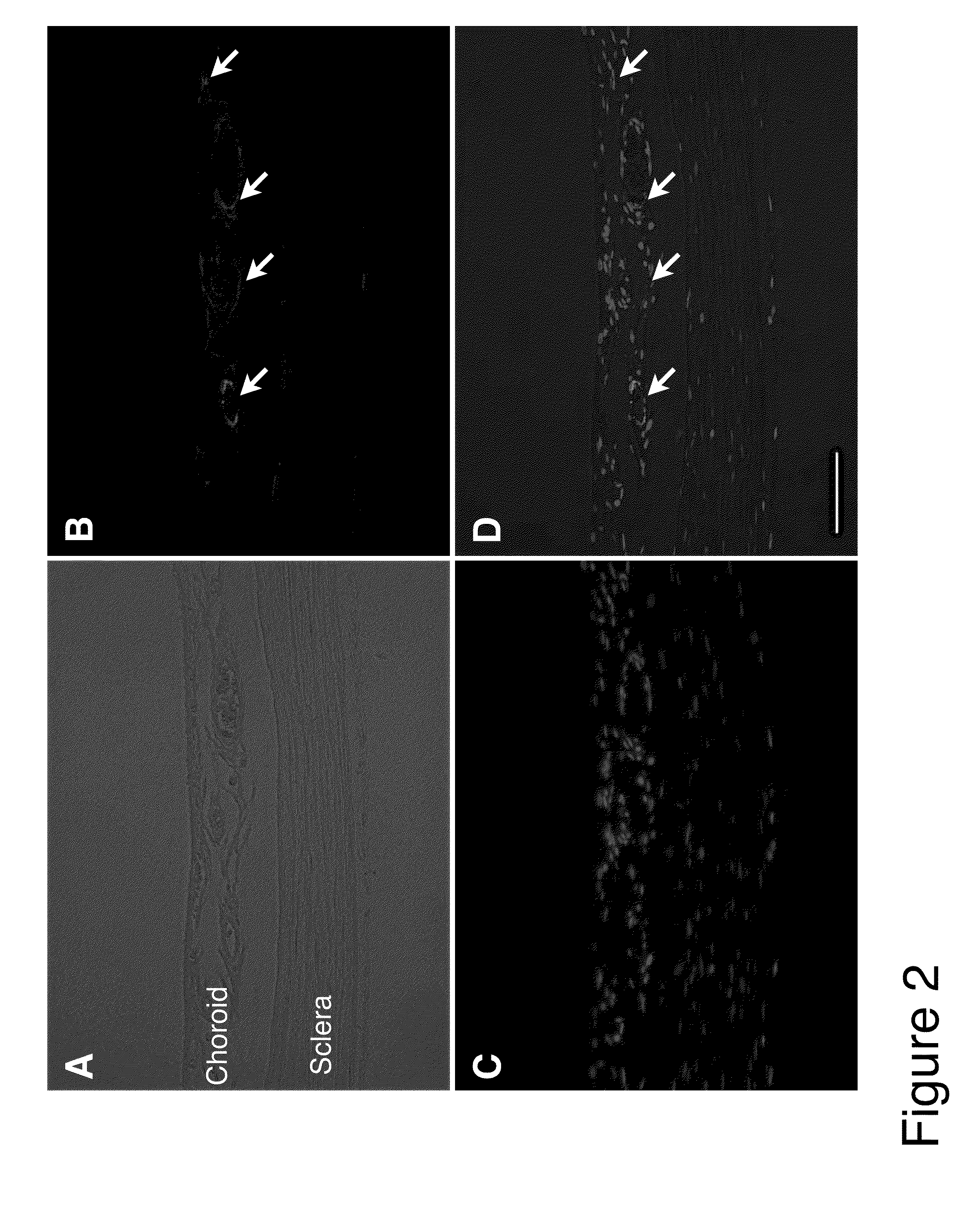 Methods and compositions for treating conditions associated with angiogenesis using a vascular adhesion protein-1 (vap 1) inhibitor