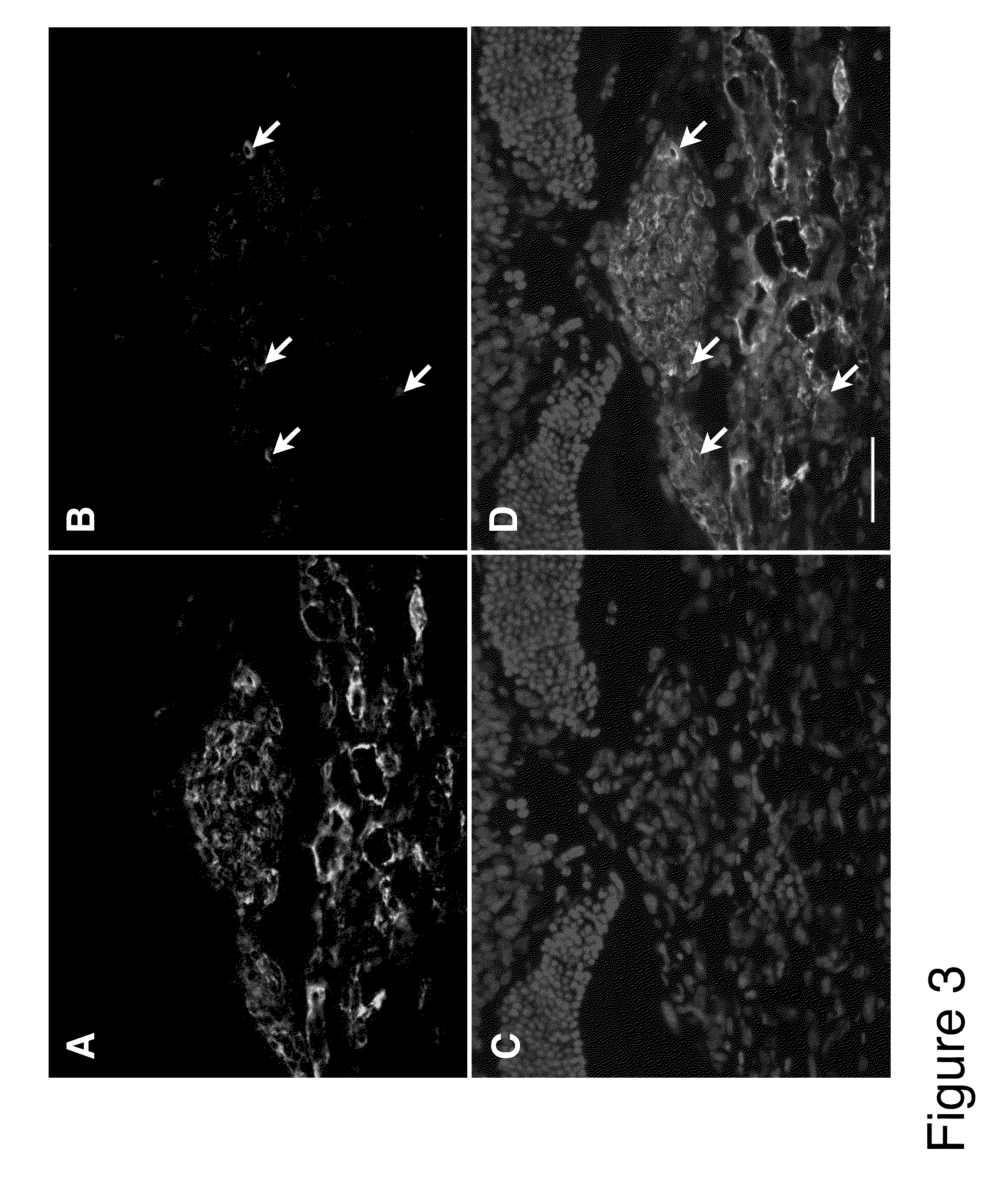 Methods and compositions for treating conditions associated with angiogenesis using a vascular adhesion protein-1 (vap 1) inhibitor