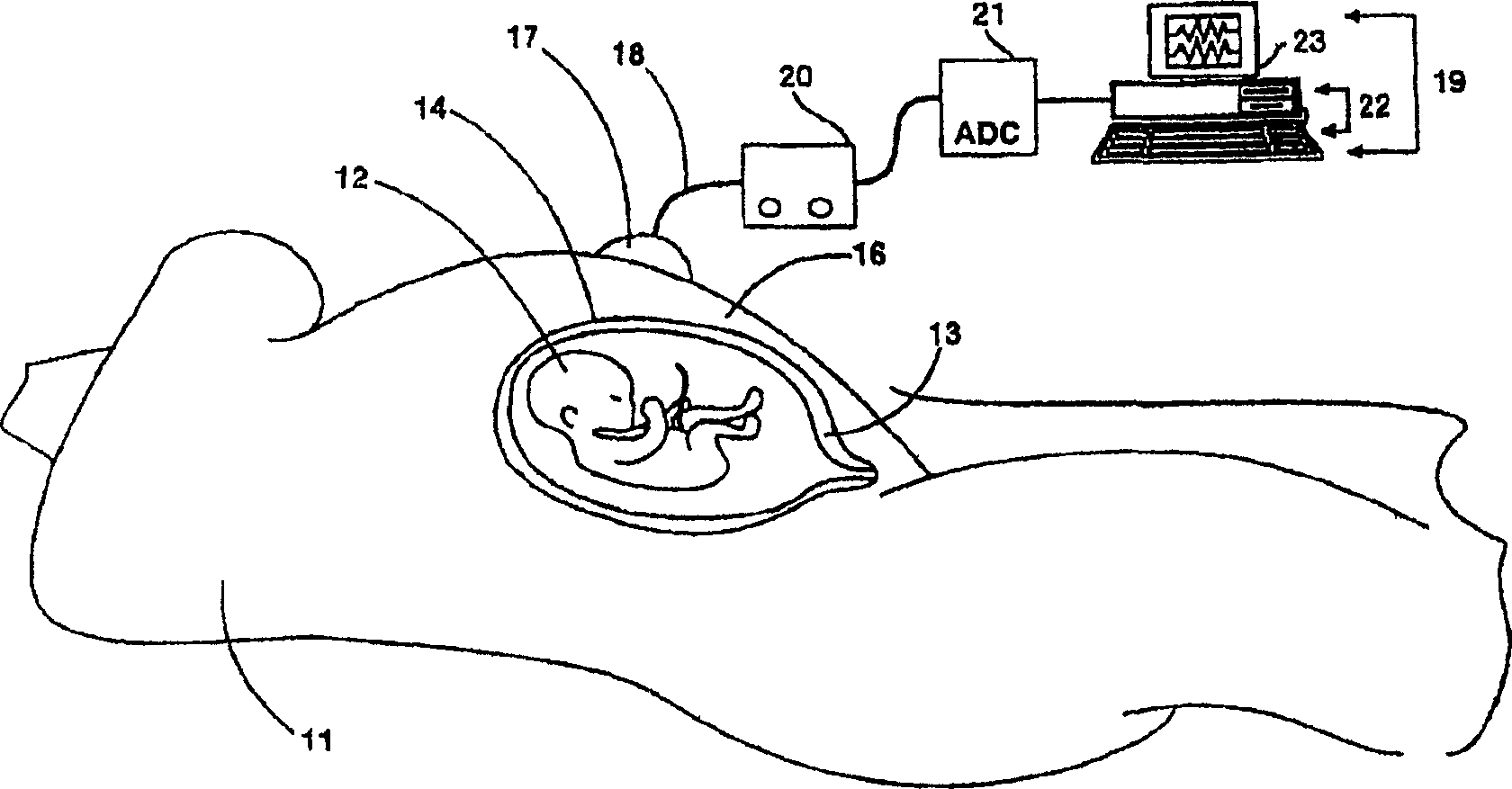System for detection and analysis of material uterine, material and fetal cardiac and fetal brain activity