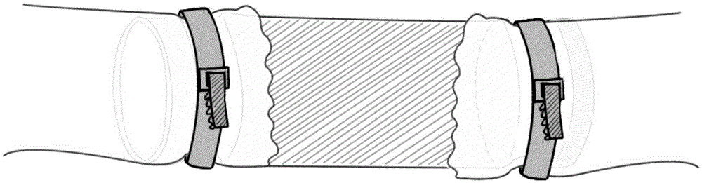 Socket components for emergency reconstruction of blood vessels and intestines