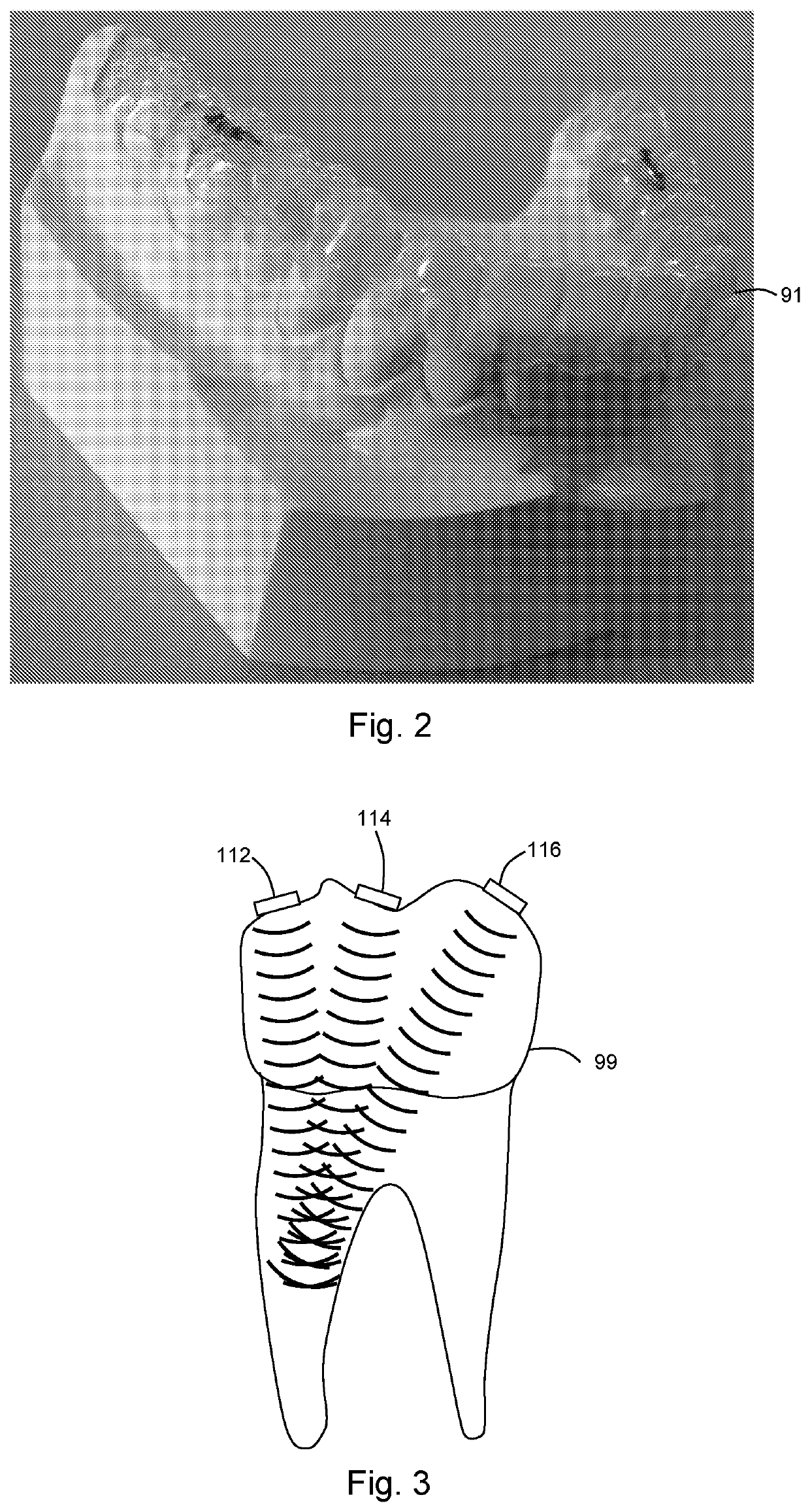 Device and Method for Accelerating Orthodontic Treatment Using Mechanical Vibrations