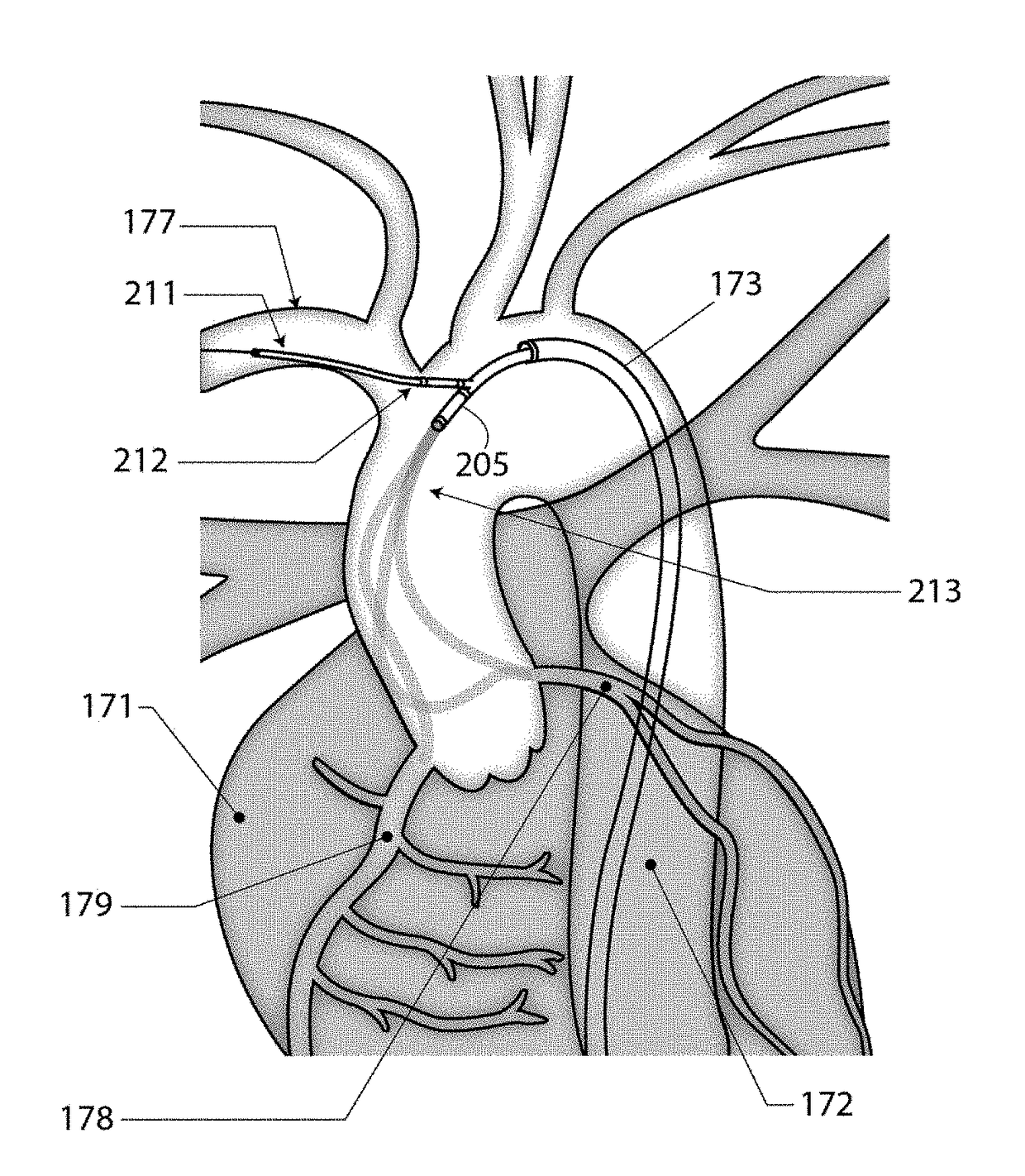 Bifurcated "y" anchor support for coronary interventions