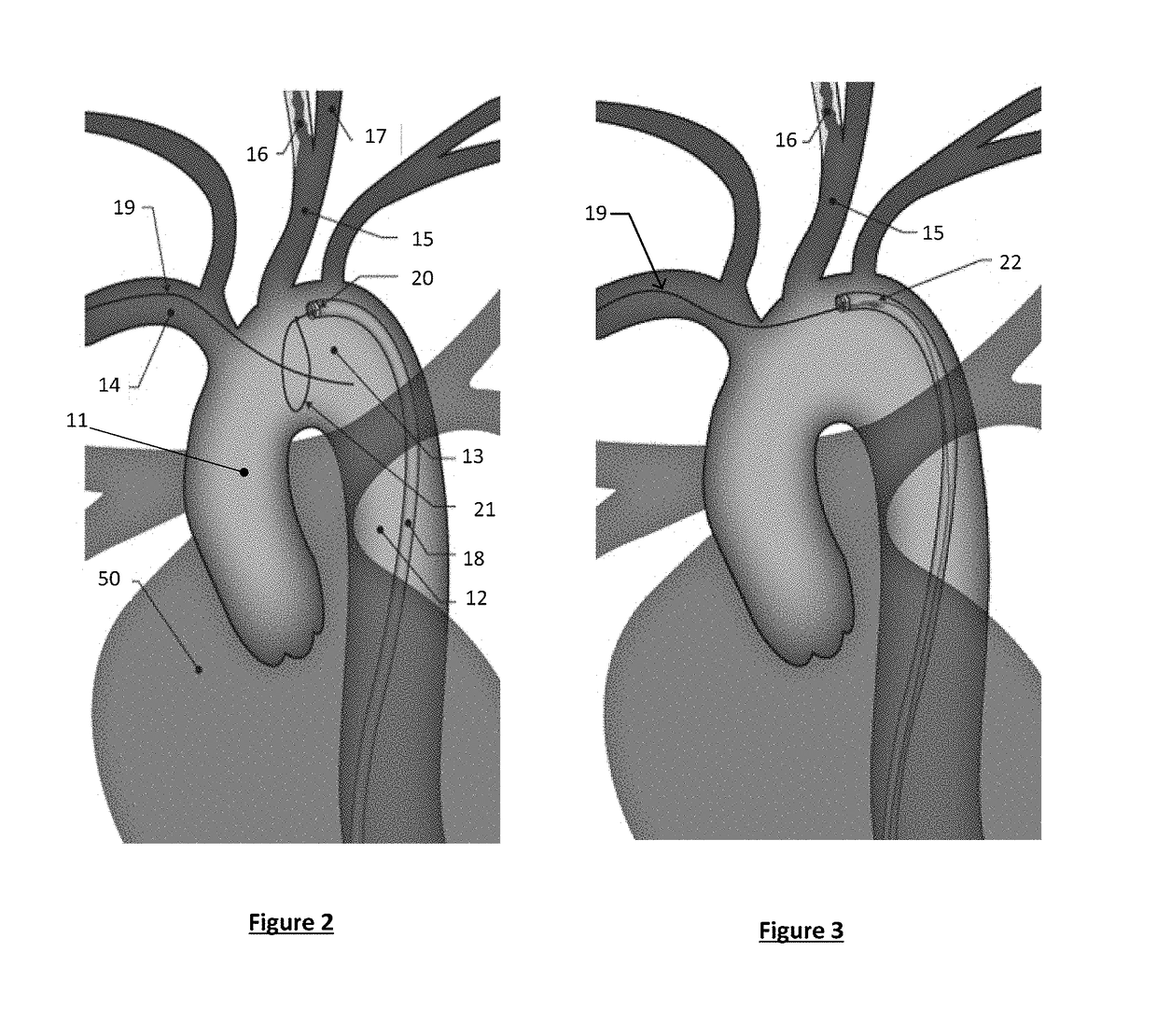 Bifurcated "y" anchor support for coronary interventions