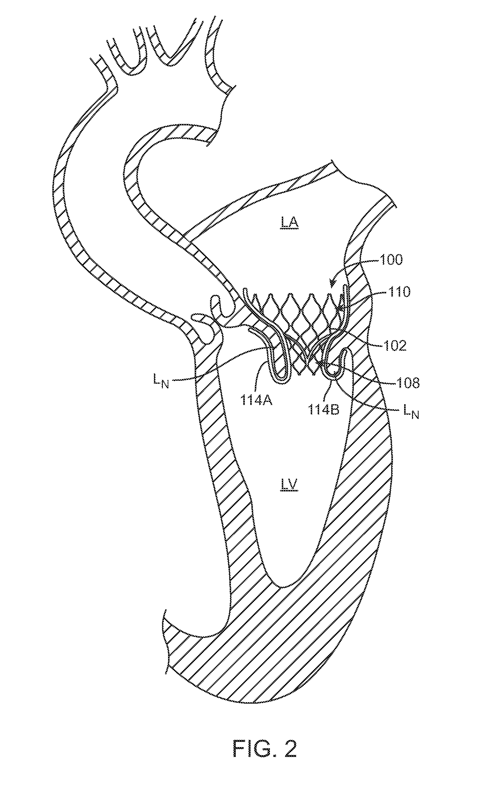 Transcatheter Valve Prosthesis and a Concurrently Delivered Sealing Component