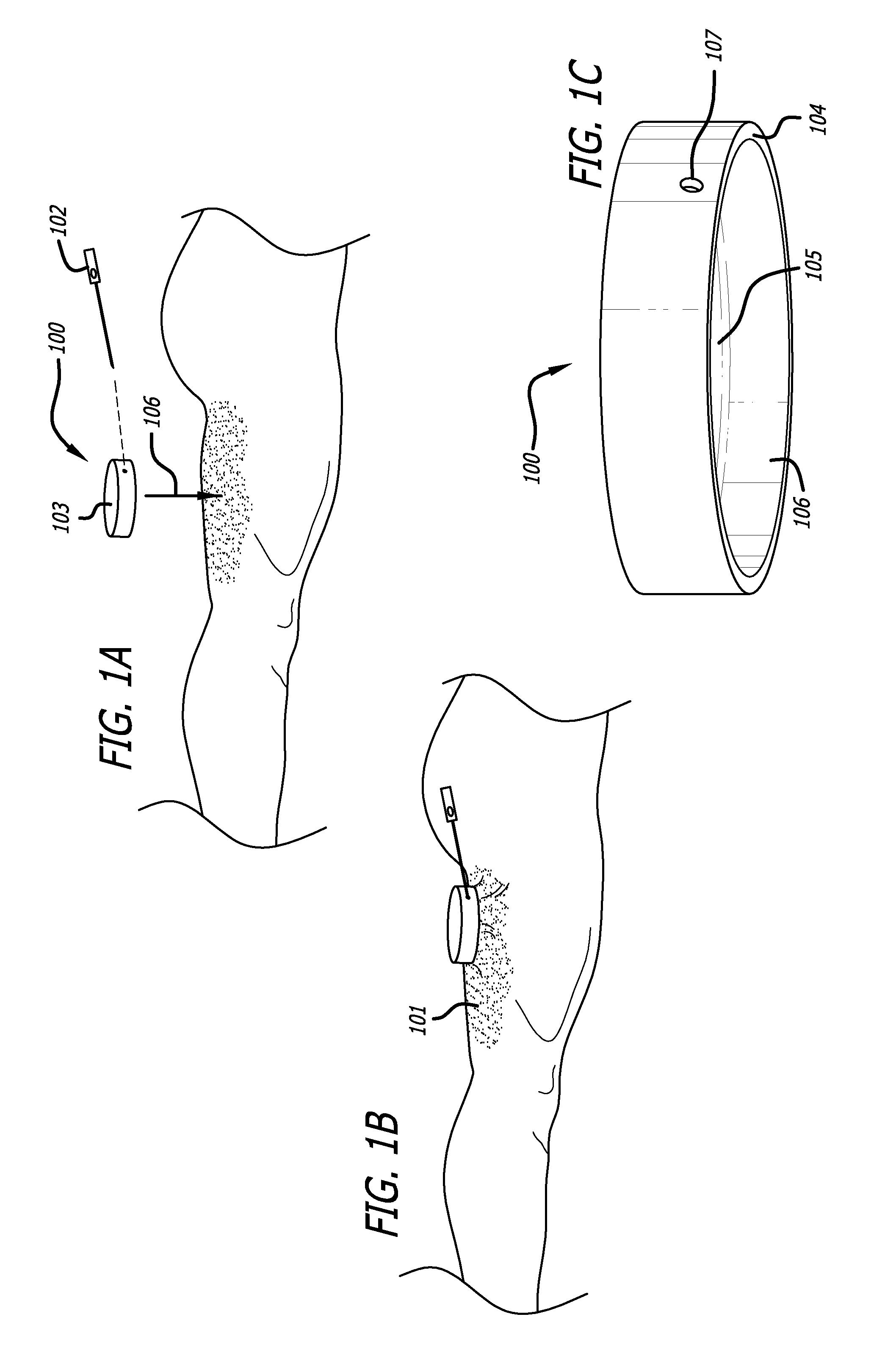 Dissection handpiece and method for reducing the appearance of cellulite