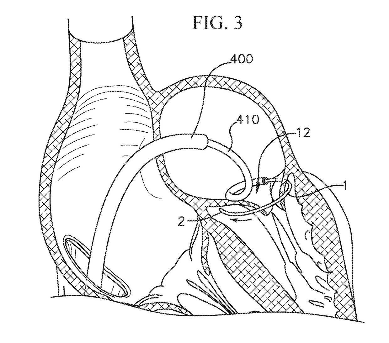 Heart valve docking system
