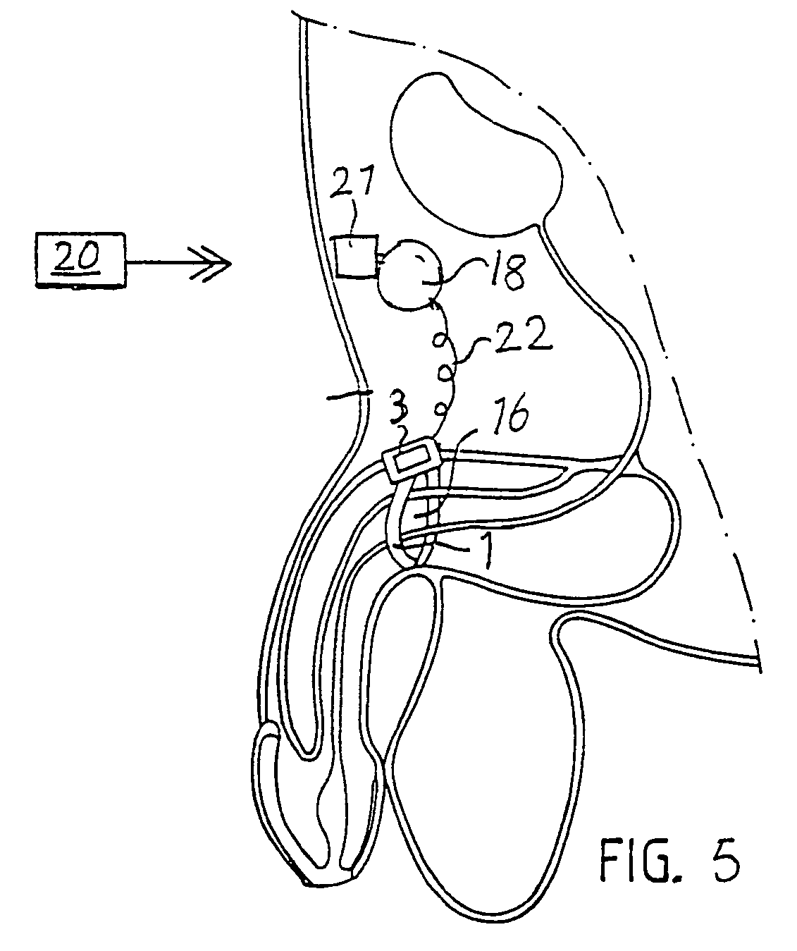 Impotence treatment apparatus with connection device
