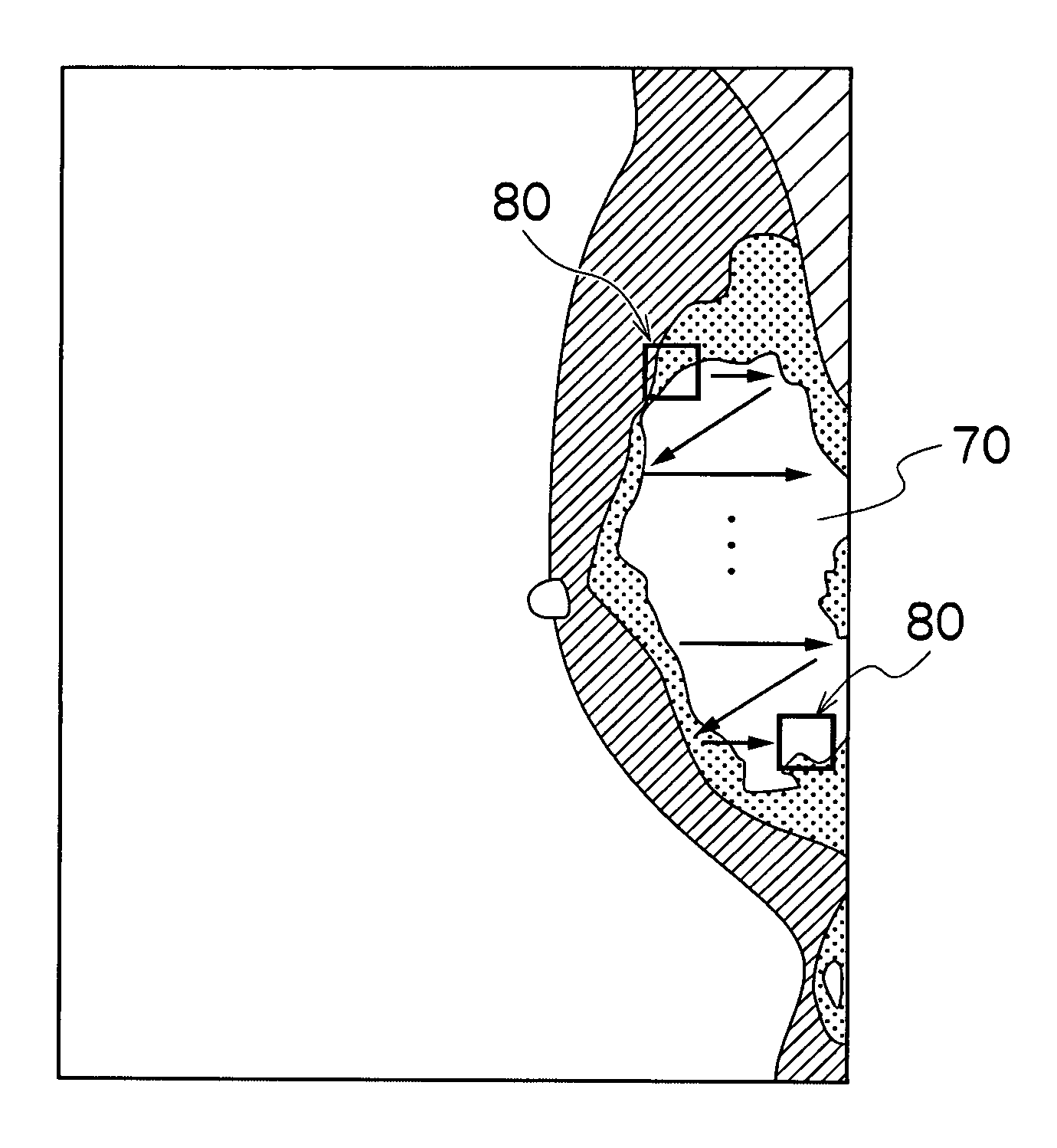 Image processing apparatus and image processing method, and recording medium for processing breast image based on local contrast values in a local region in a mammary gland region of breast image