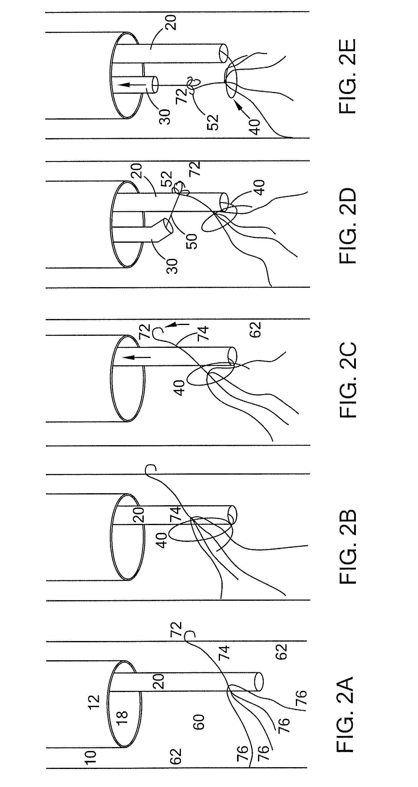 Spiral vena cava filter removal device