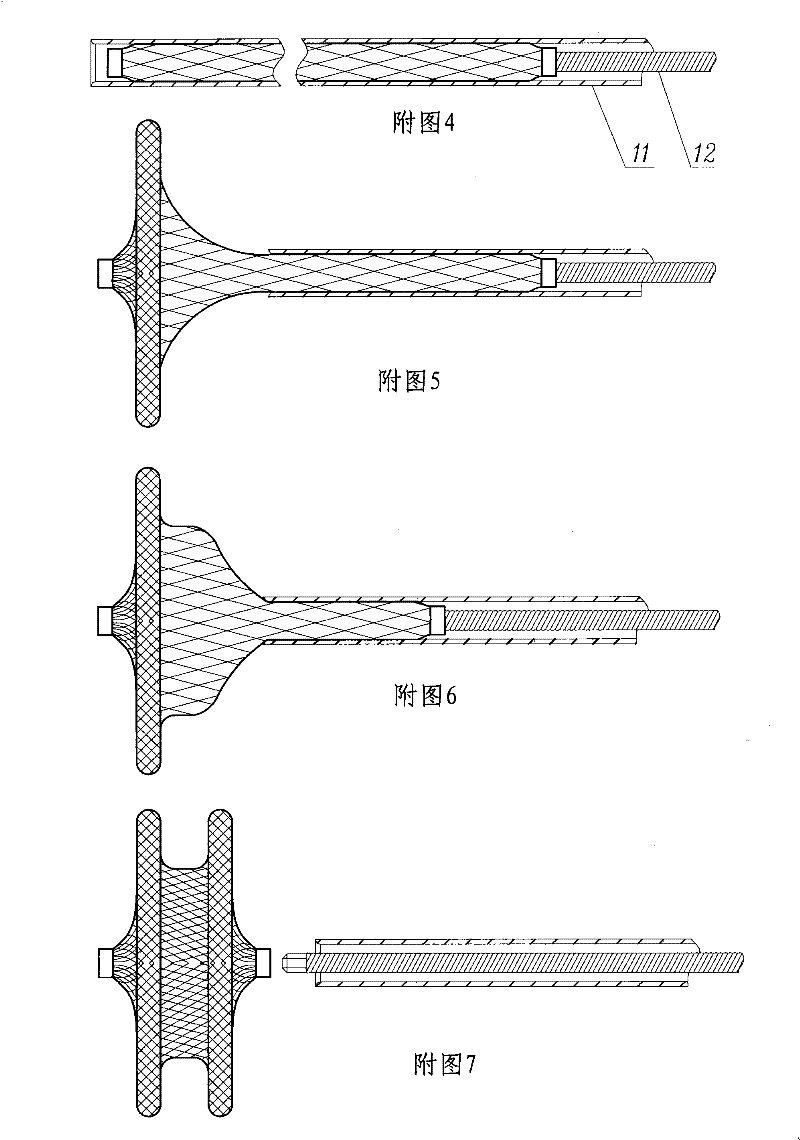 Cardiac ventricular septal defect occluder