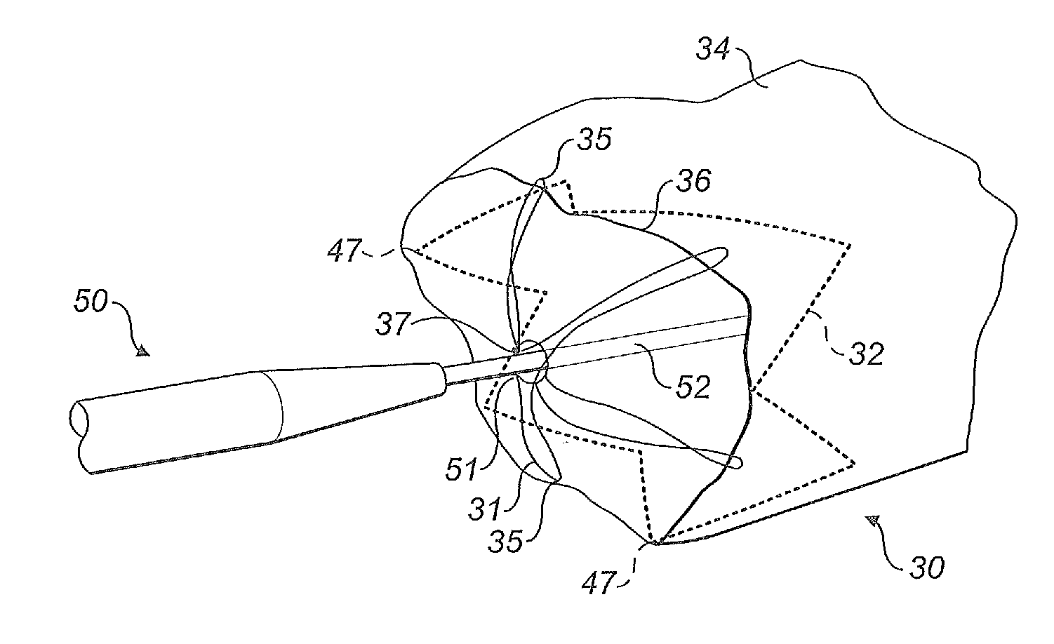 Stent graft