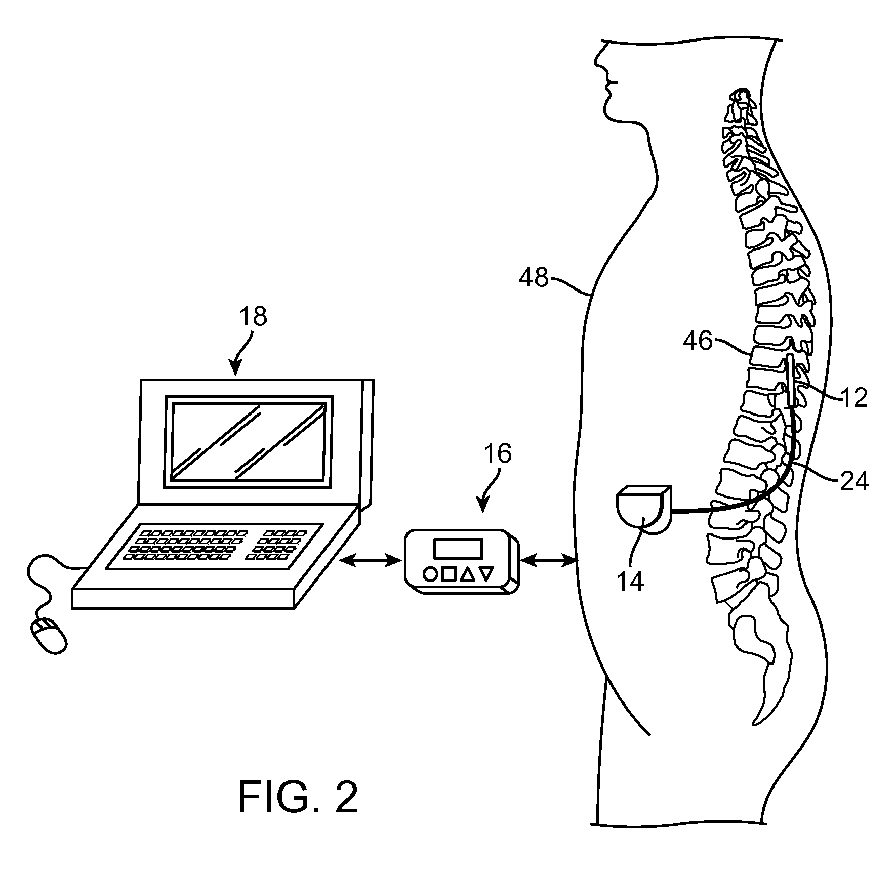 Neuromodulation using modulated pulse train