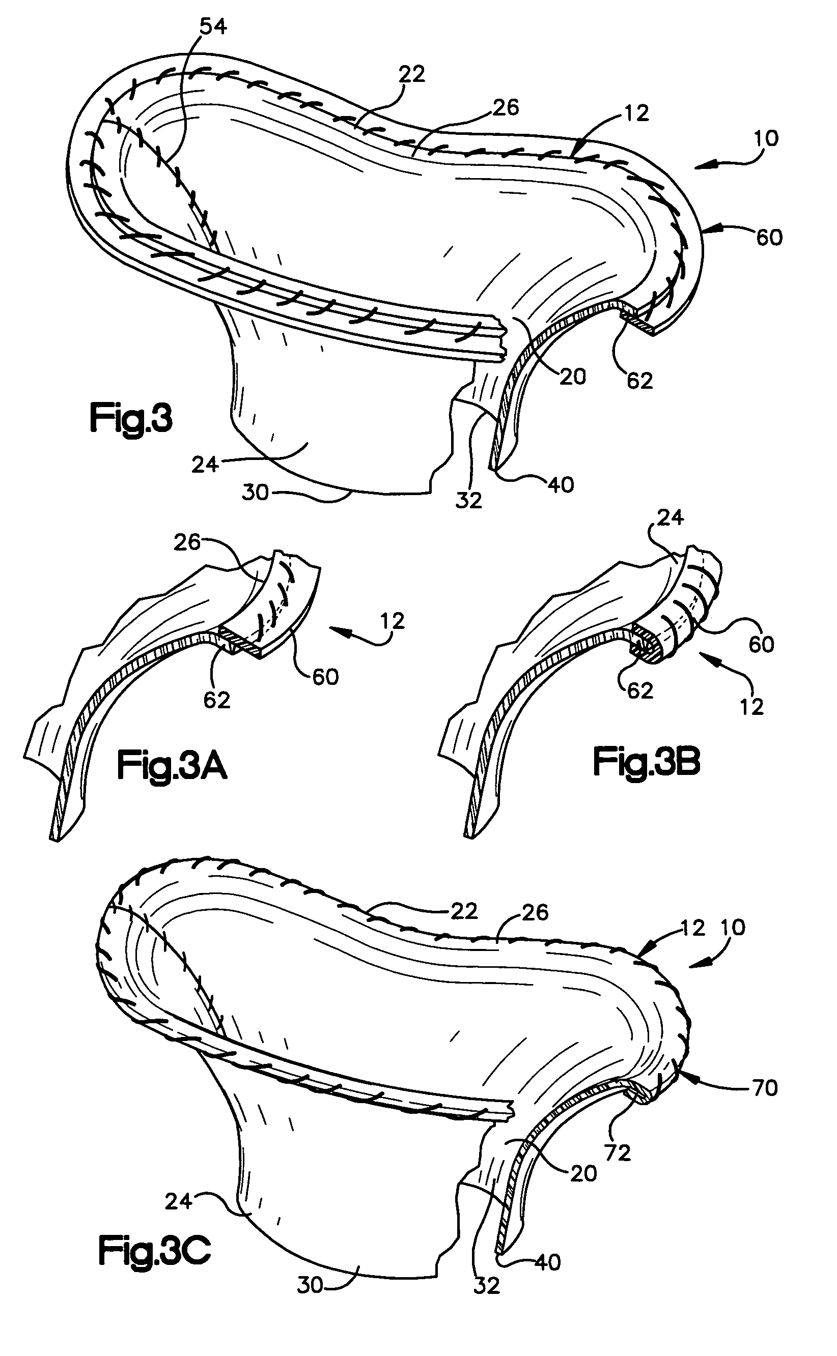 Method and apparatus for replacing a mitral valve with a stentless bioprosthetic valve