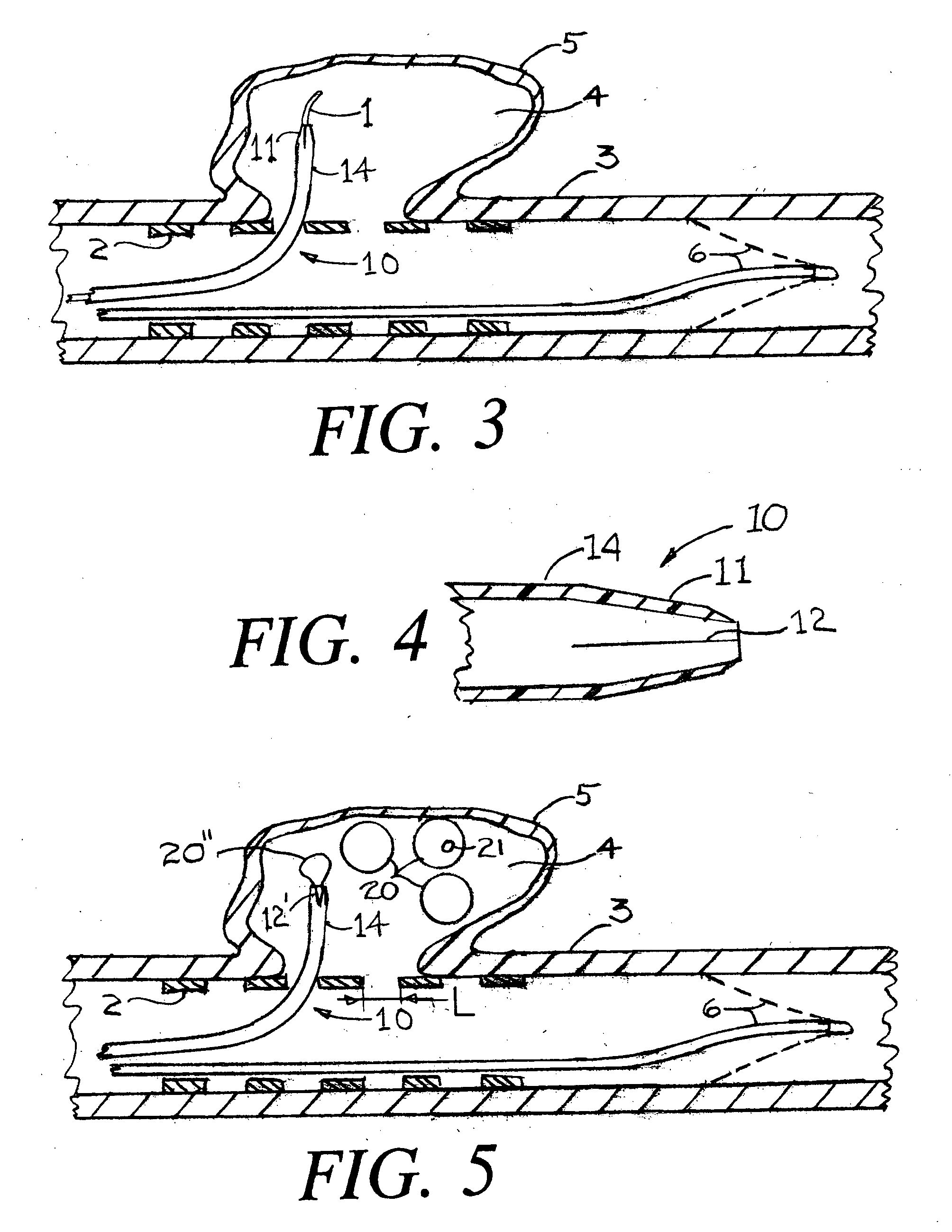 Means and method for the treatment of cerebral aneurysms