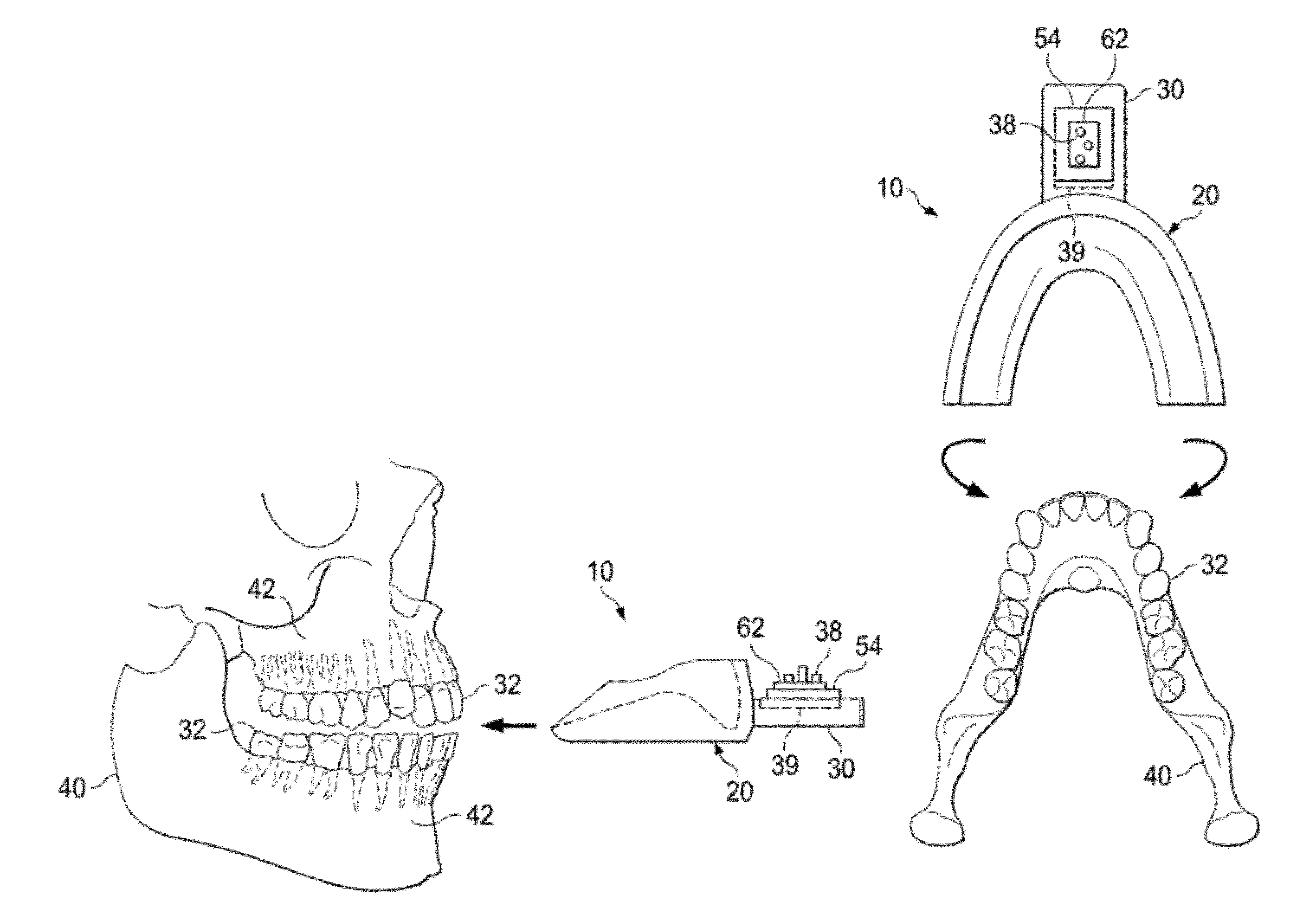 Vibrating orthodontic remodelling device