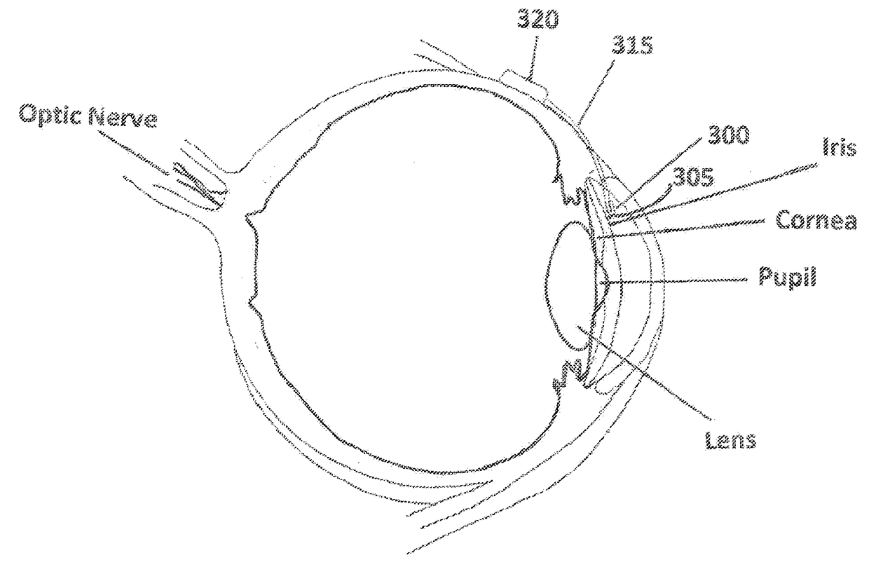 Ocular filtration devices, systems and methods