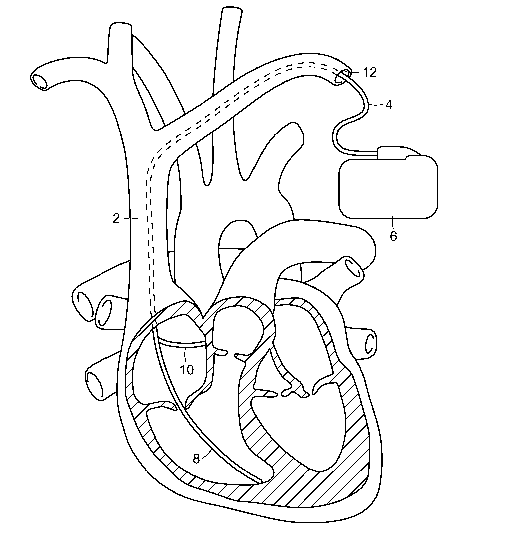 Cardiac pacemaker and uses thereof