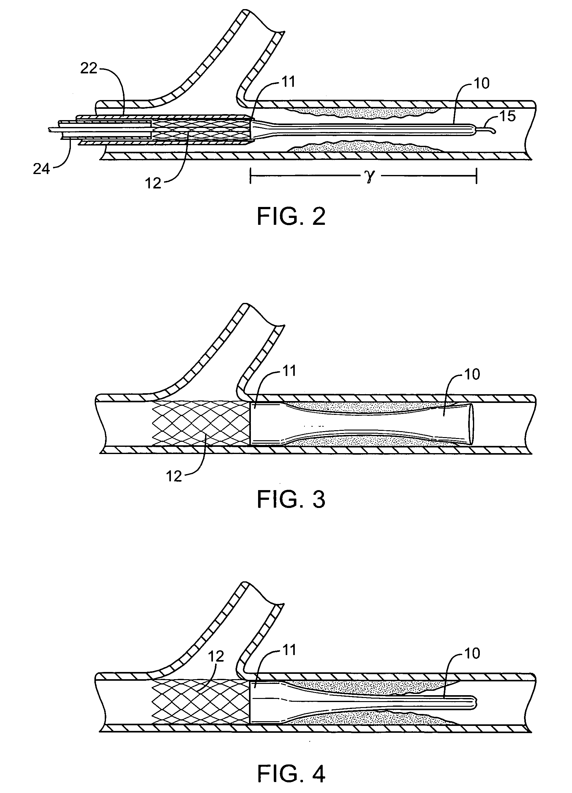 Methods and devices for protecting passageway in a body when advancing devices through the passageway