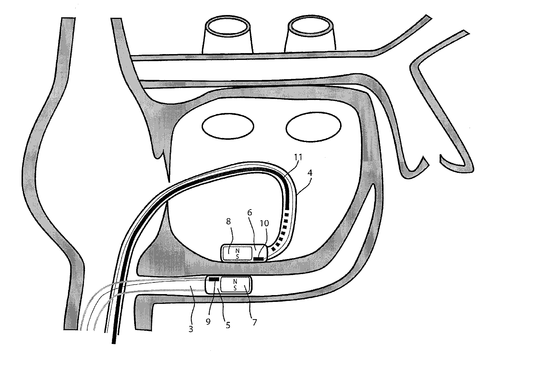 Medical device for tissue ablation