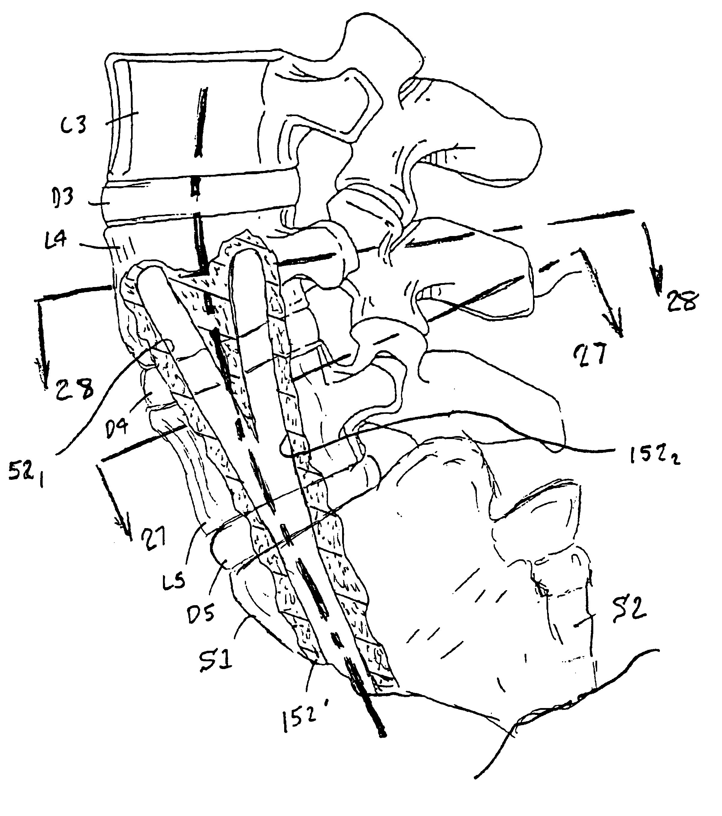 Methods and apparatus for forming curved axial bores through spinal vertebrae