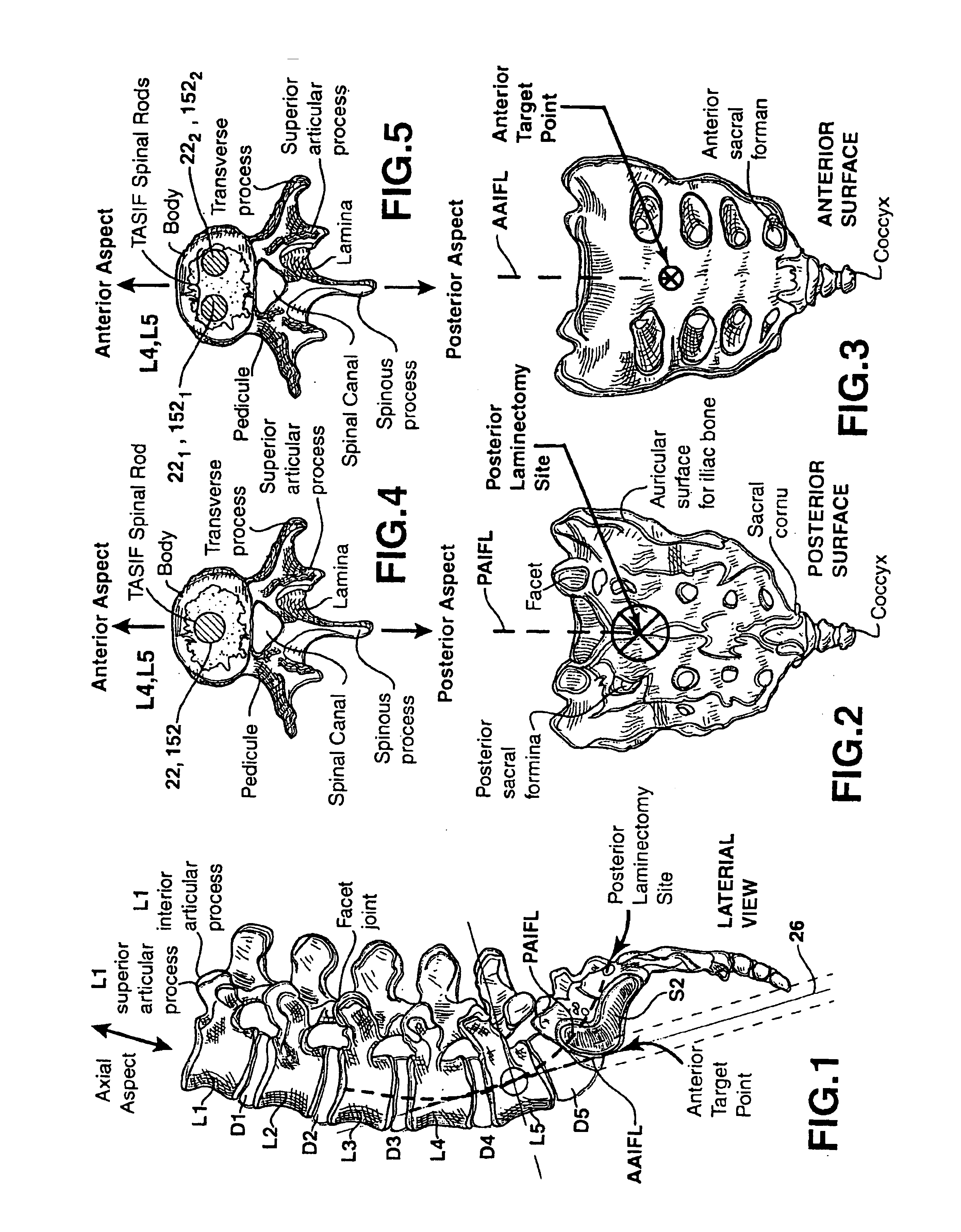 Methods and apparatus for forming curved axial bores through spinal vertebrae