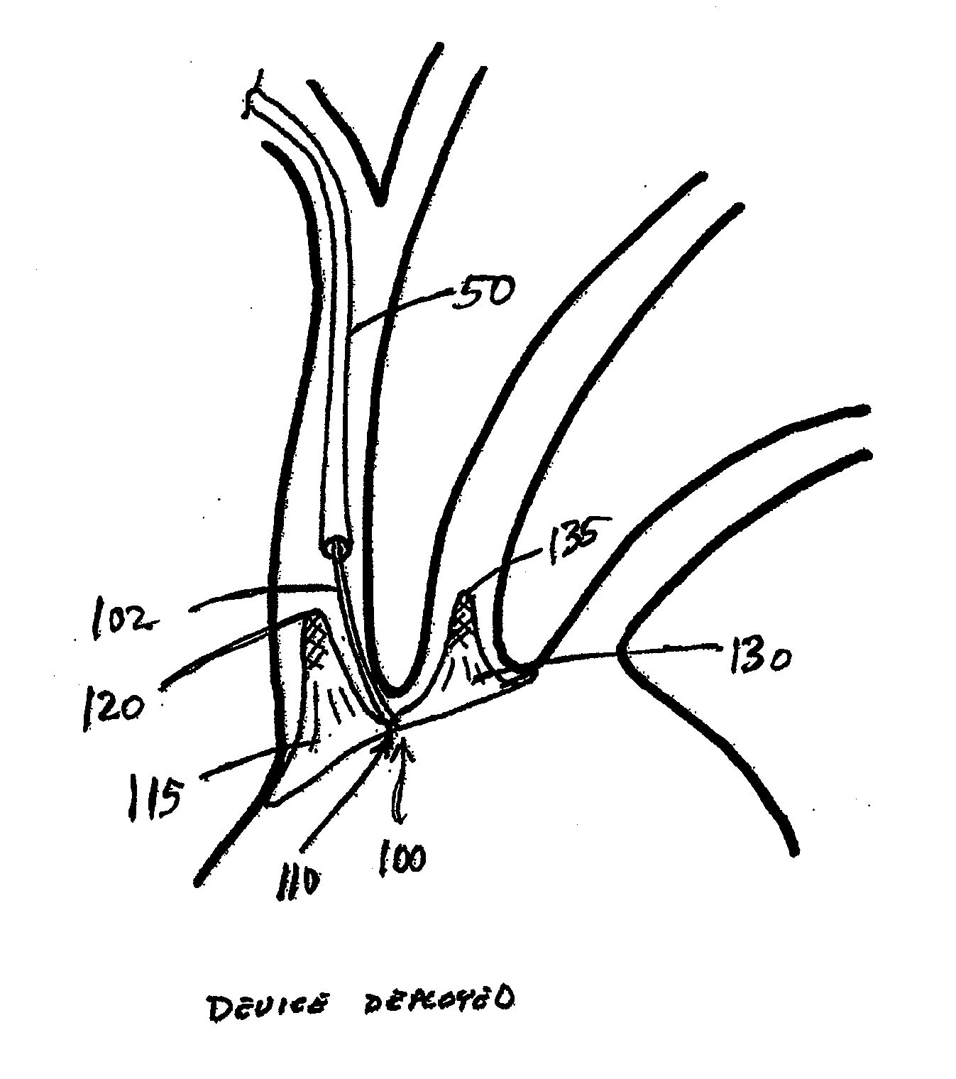 Dual endovascular filter and methods of use