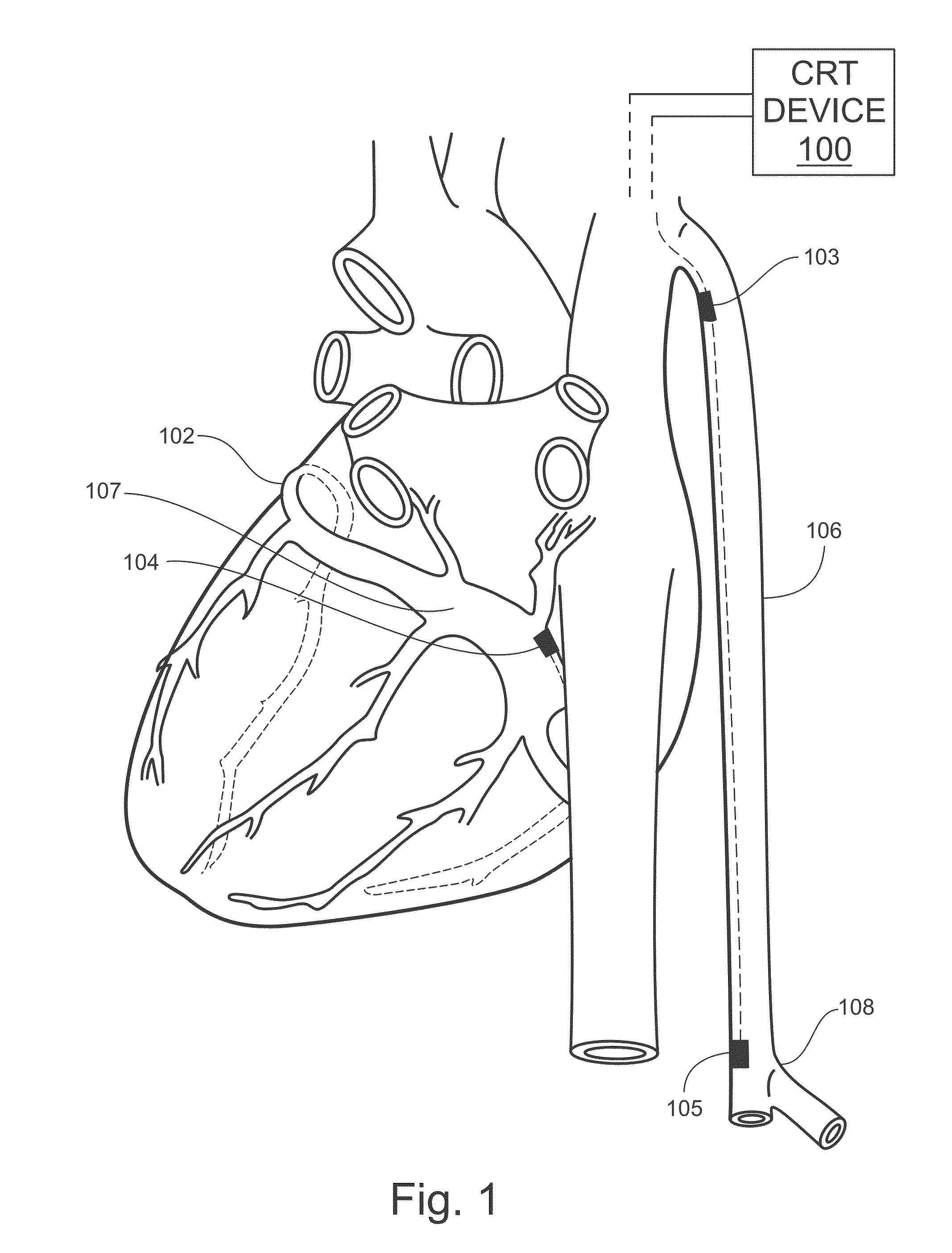 Systems and methods for optimizing cardiac resynchronization therapy (CRT)