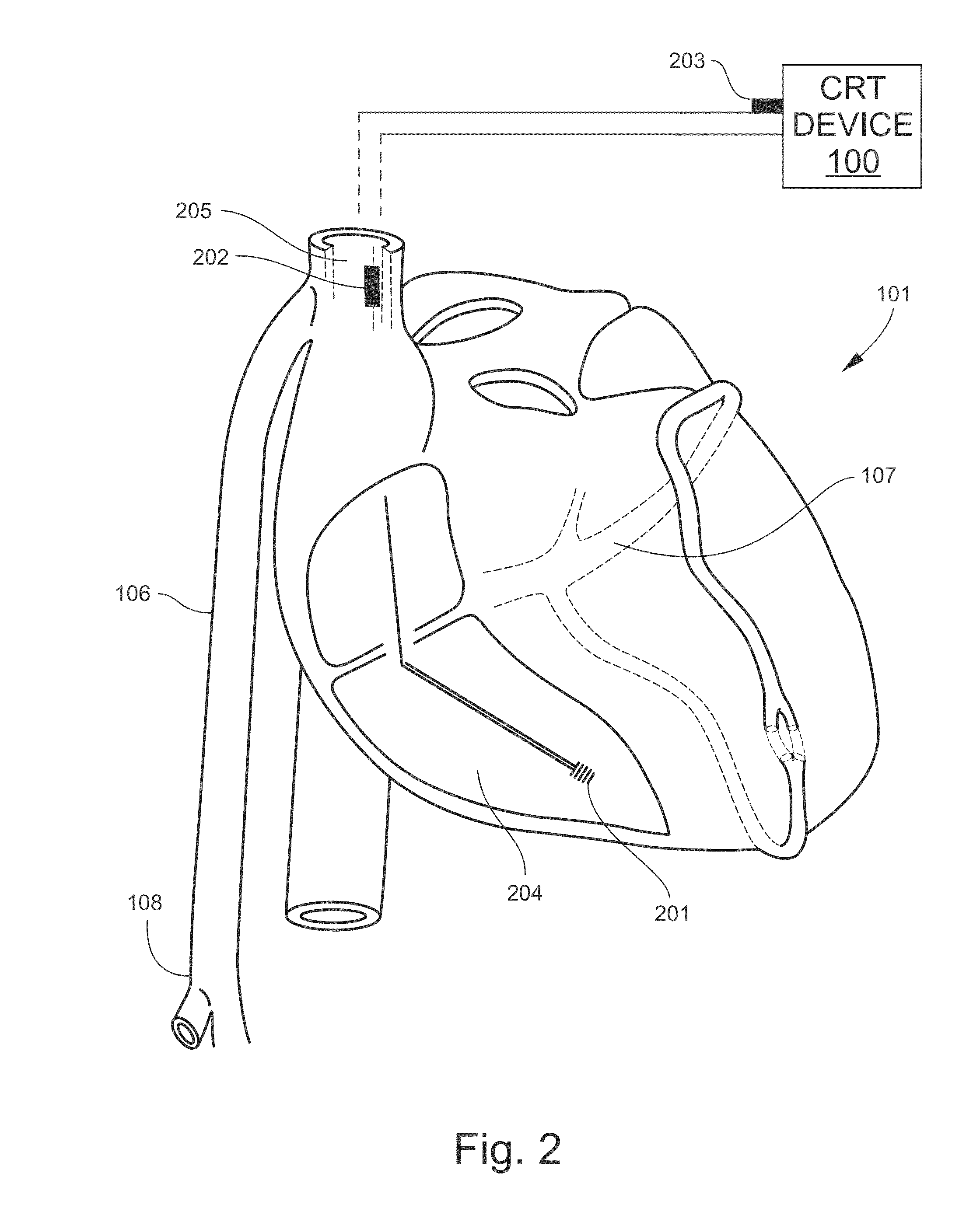 Systems and methods for optimizing cardiac resynchronization therapy (CRT)