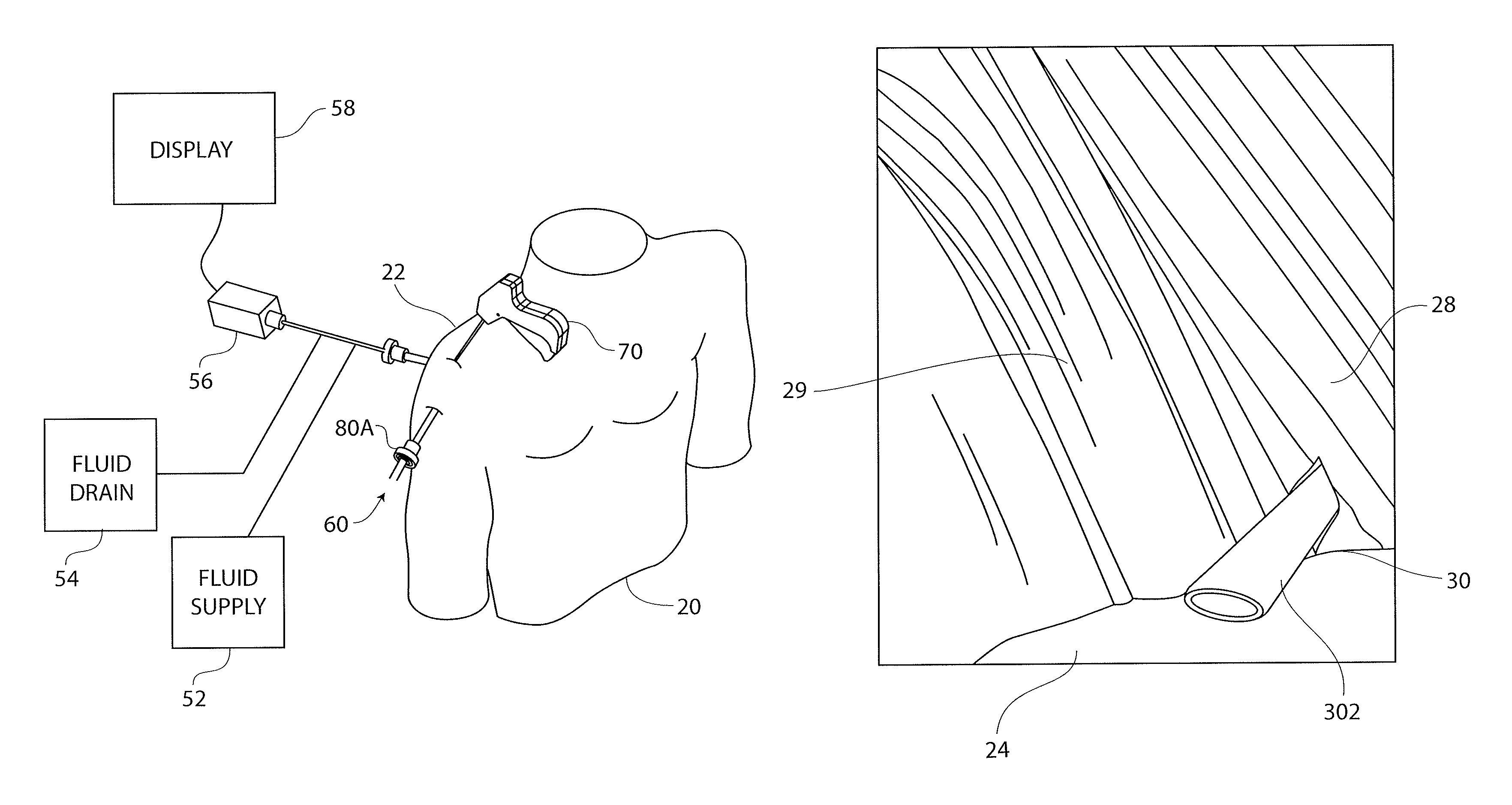 Anatomical location markers and methods of use in positioning sheet-like materials during surgery