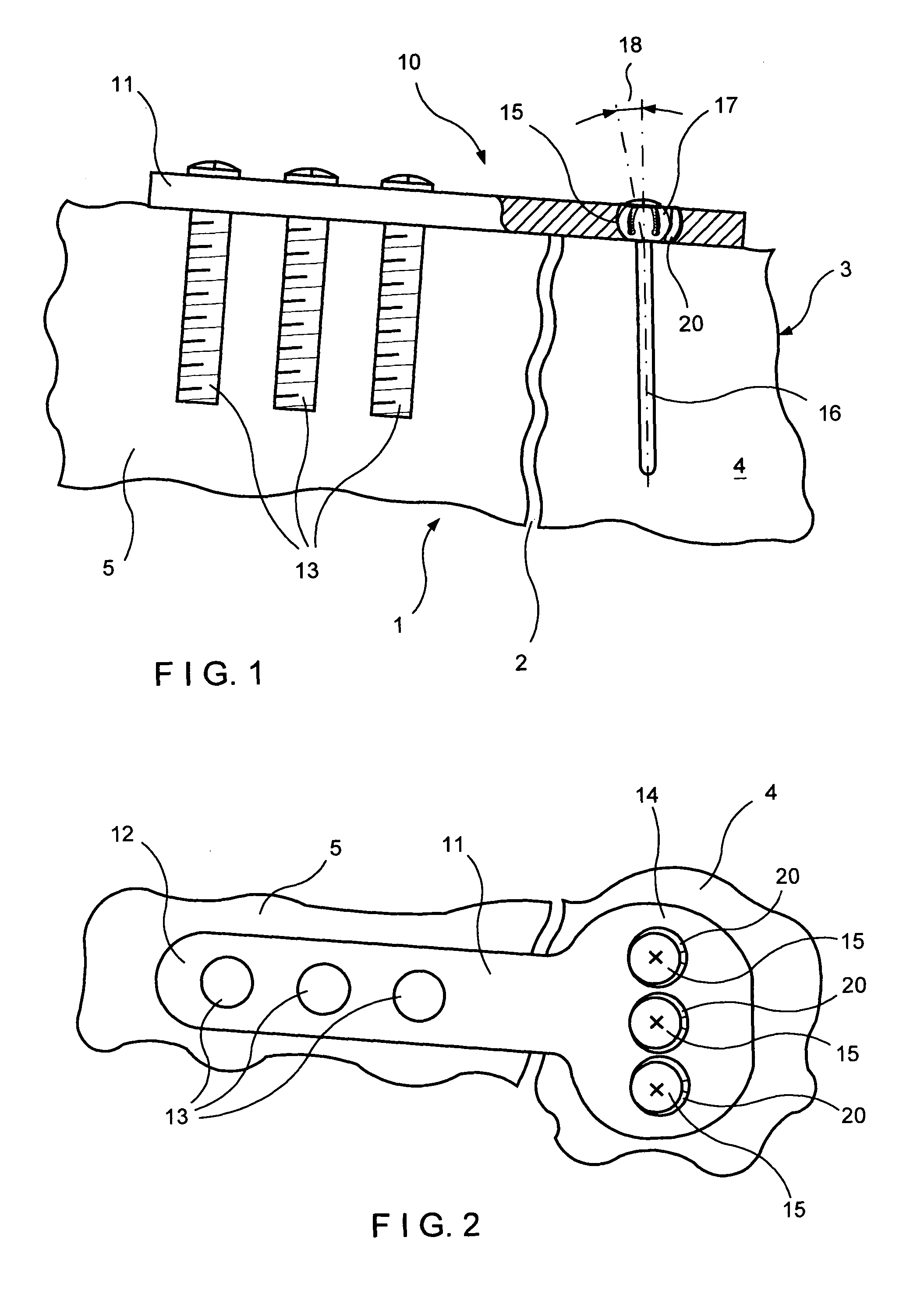Bearing plate for use in fracture fixation having a spherical bearing hole with yielding expandability