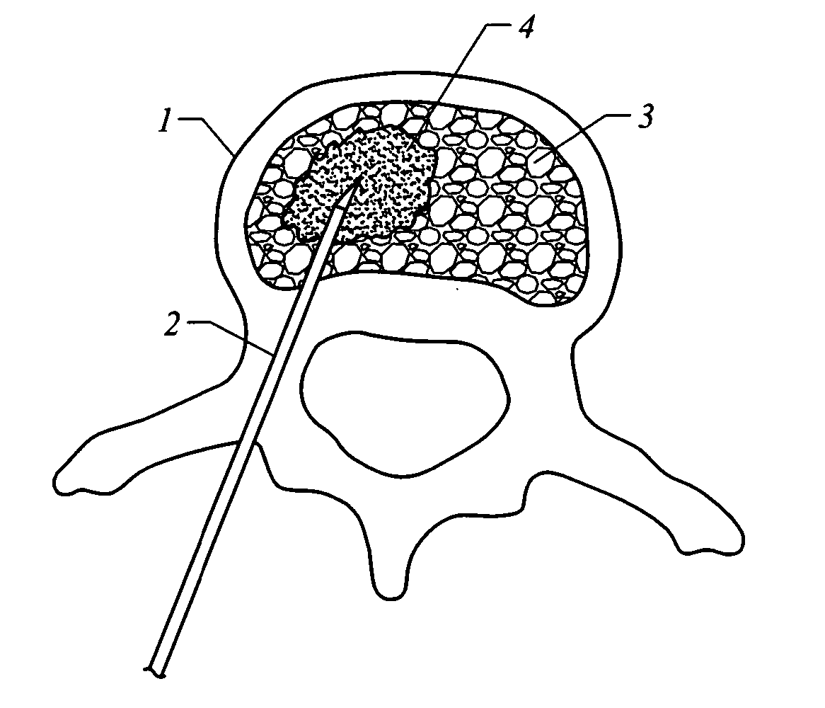 Electrosurgical method and apparatus for removing tissue within a bone body