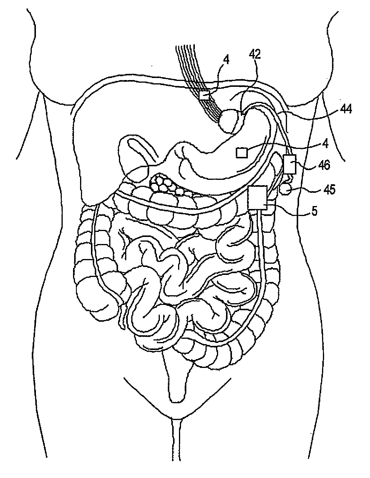 Artificial gastric valve