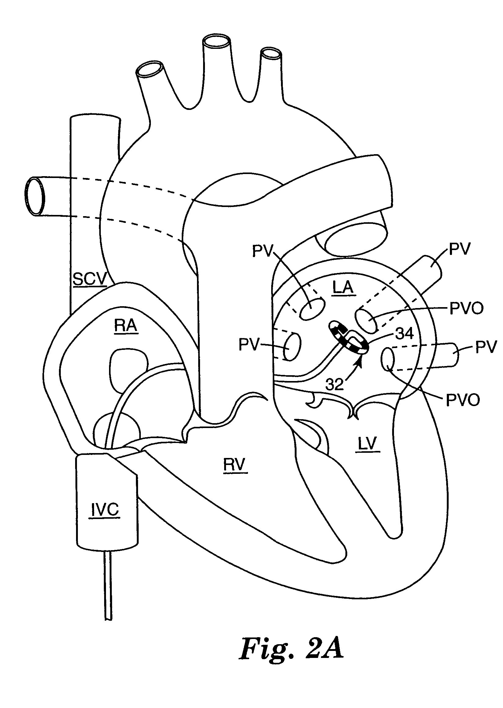 Ablation catheter assembly with radially decreasing helix and method of use