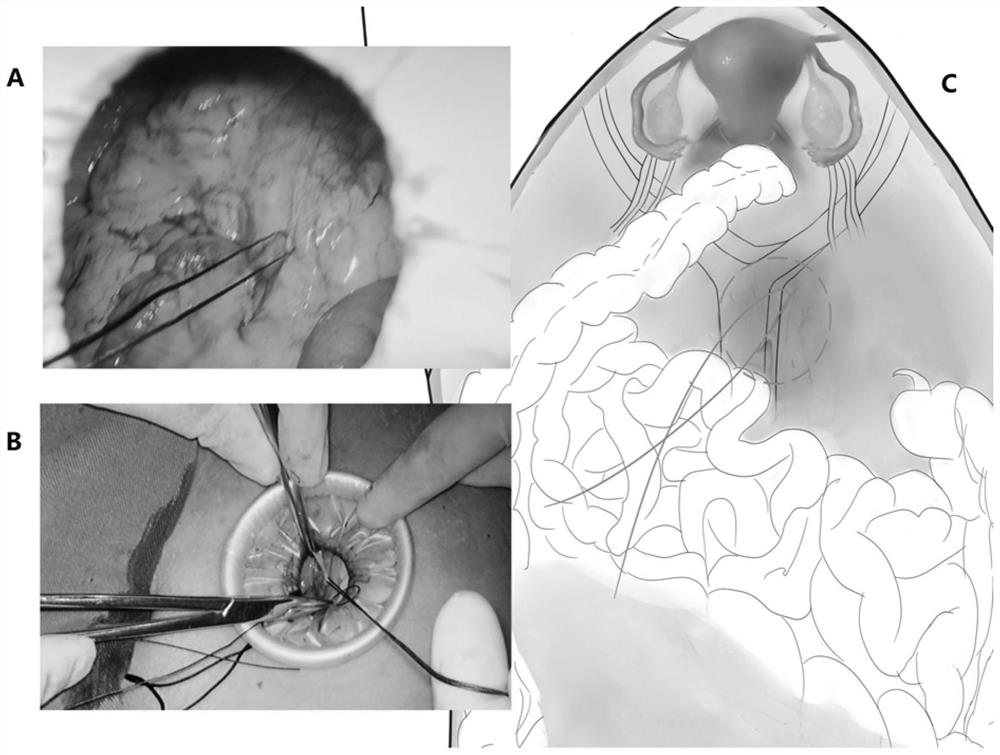 Method for transumbilical single-port extraperitoneal route lymph node excision