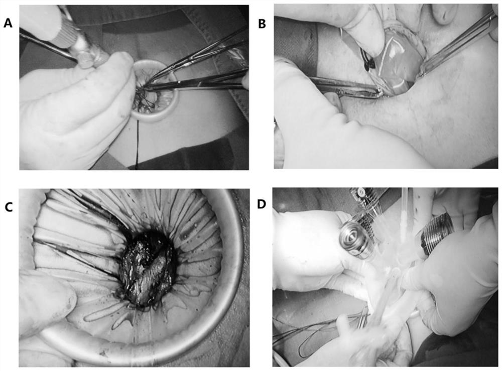 Method for transumbilical single-port extraperitoneal route lymph node excision