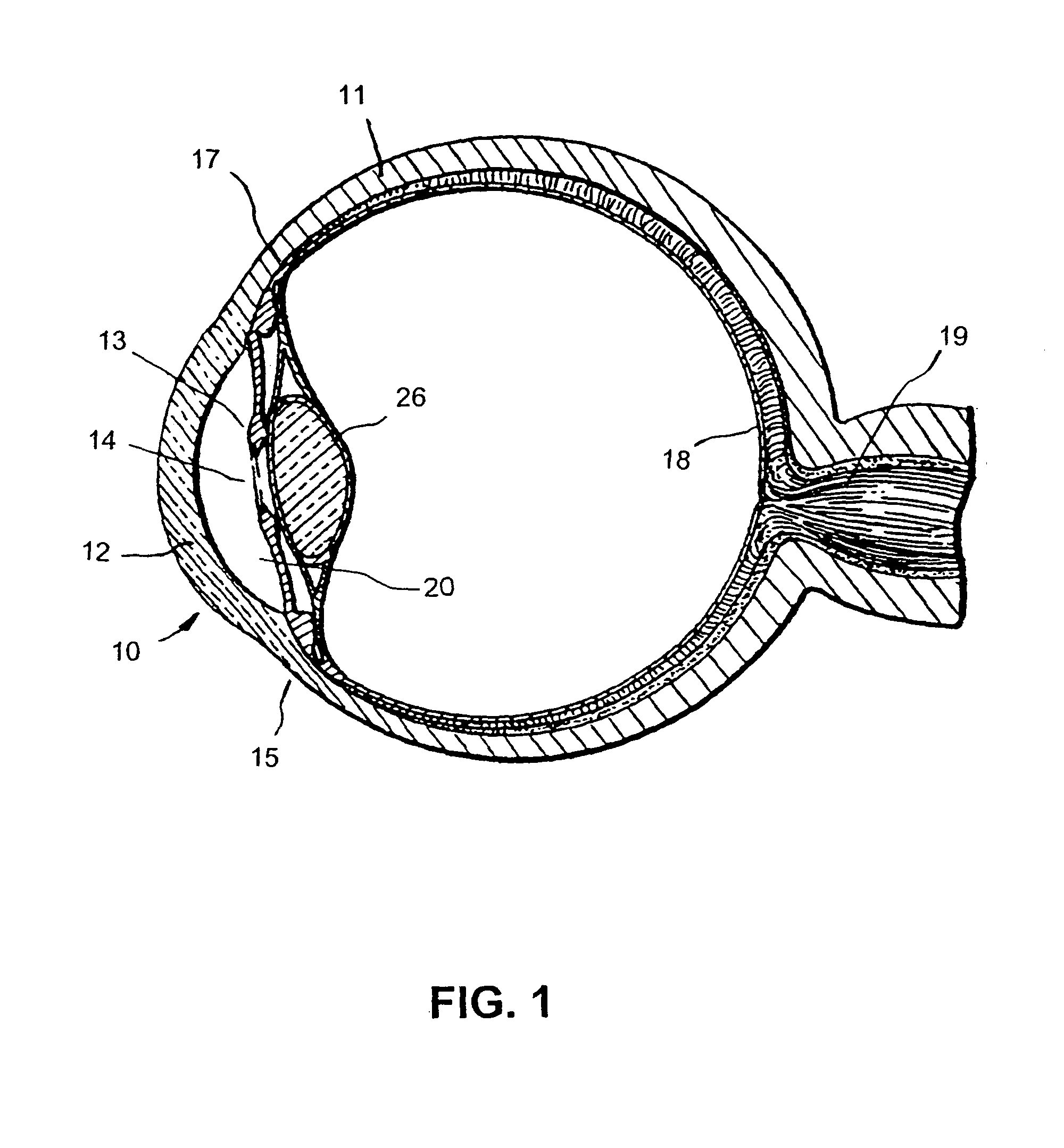 Implant with pressure sensor for glaucoma treatment
